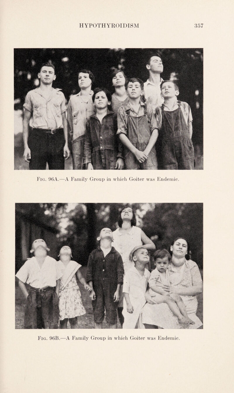 Fig. 96A.—A Family Group in which Goiter was Endemic. Fig. 96B.—A Family Group in which Goiter was Endemic