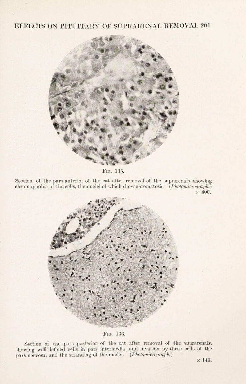 Section of the pars anterior of the cat after removal of the suprarenals, showing chromophobia of the cells, the nuclei of which show chromatosis. {Photomicrograph.) X 400. Fig. 136. Section of the pars posterior of the cat after removal of the suprarenals, showing well-defined cells in pars intermedia, and invasion by these cells of the pars nervosa, and the stranding of the nuclei. {Photomicrograph.) Fig, 135. X 140.