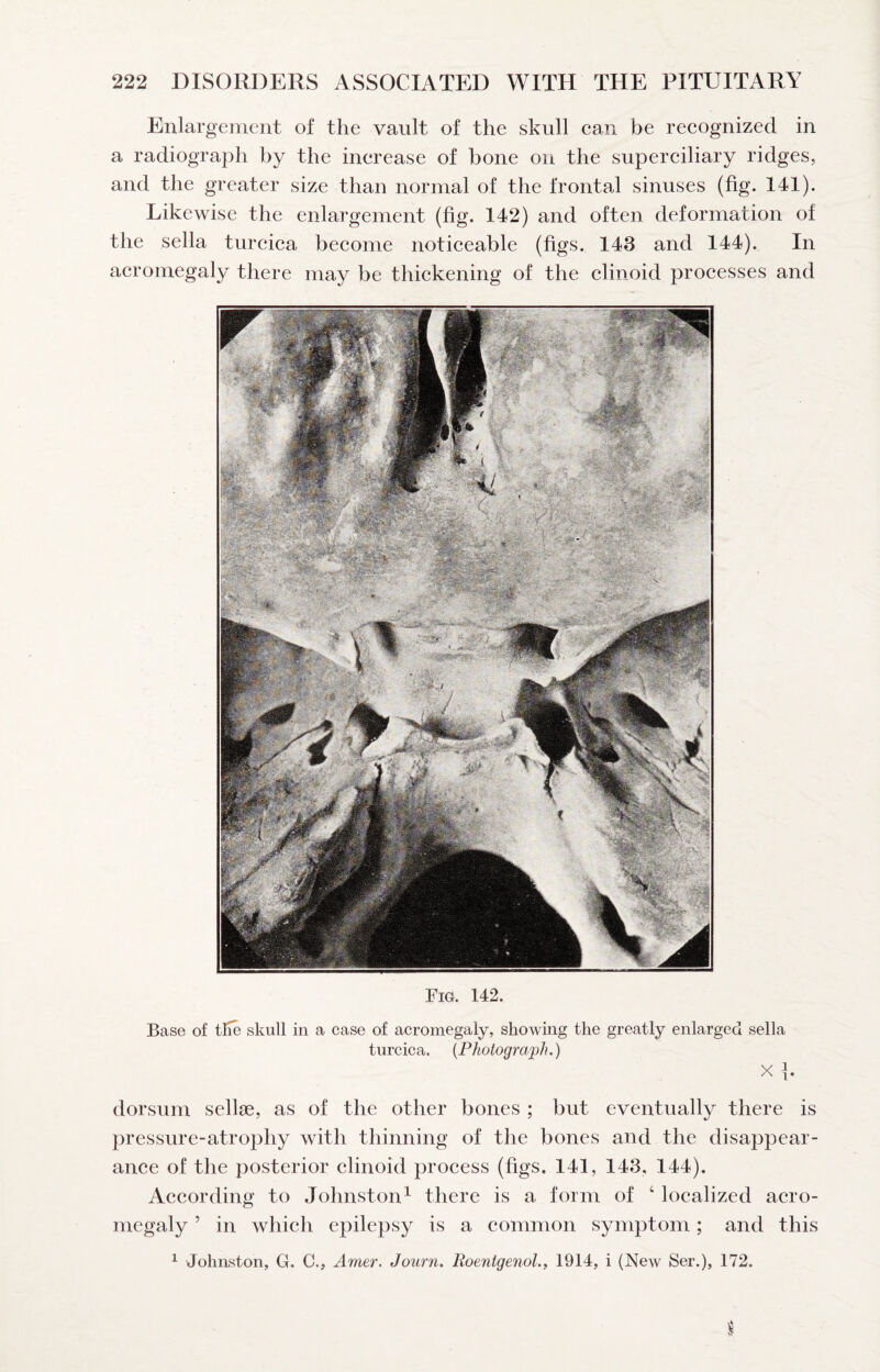 Enlargement of the vault of the skull can be recognized in a radiograph by the increase of bone on the superciliary ridges^ and the greater size than normal of the frontal sinuses (fig. 141). Likewise the enlargement (fig. 142) and often deformation of the sella turcica become noticeable (figs. 143 and 144). In acromegaly there may be thickening of the clinoid processes and Fig. 142. Base of tlie skull in a case of acromegaly, showing the greatly enlarged sella turcica. {Photograph.) X dorsum sellae, as of the other bones ; but eventually there is pressure-atrophy with thinning of the bones and the disappear¬ ance of the posterior clinoid process (figs. 141, 143, 144). According to Johnston^ there is a form of ‘ localized acro¬ megaly ’ in which epilepsy is a common symptom; and this ^ Johnston, G. C., Amer. Journ. Roentgenol.^ 1914, i (New Ser.), 172.