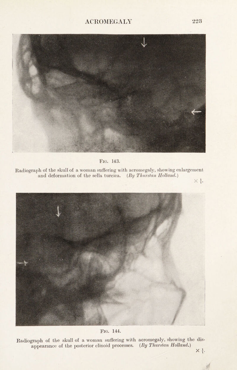 Fig. 143. Radiograph of the skull of a woman suffering with acromegaly, and deformation of the sella turcica. {By Tlmrsiaii showing enlargement Holland,) X I- j Fig. 144. Radiograph of the skull of a woman suffering with appearance of the posterior clinoid processes. acromegaly, showing the dis- {By Thurstan Holland.) X\,