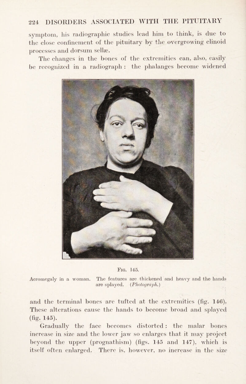 symptom, his radiographic studies lead him to think, is due to the close confinement of the pituitary by the overgrowing clinoid processes and dorsum sellse. The changes in the bones of the extremities ean, also, easily be recognized in a radiograph : the phalanges become widened Fig. 145. Acromegaly in a woman. The features are thickened and heavy and the hands are splayed. {Photograph.) and the terminal bones are tufted at the extremities (fig. 146). These alterations cause the hands to beeome broad and splayed (fig. 145). Gradually the face becomes distorted : the malar bones increase in size and the lower jaw so enlarges that it may project beyond the upper (prognathism) (figs. 145 and 147), which is itself often enlarged. There is, however, no inerease in the size