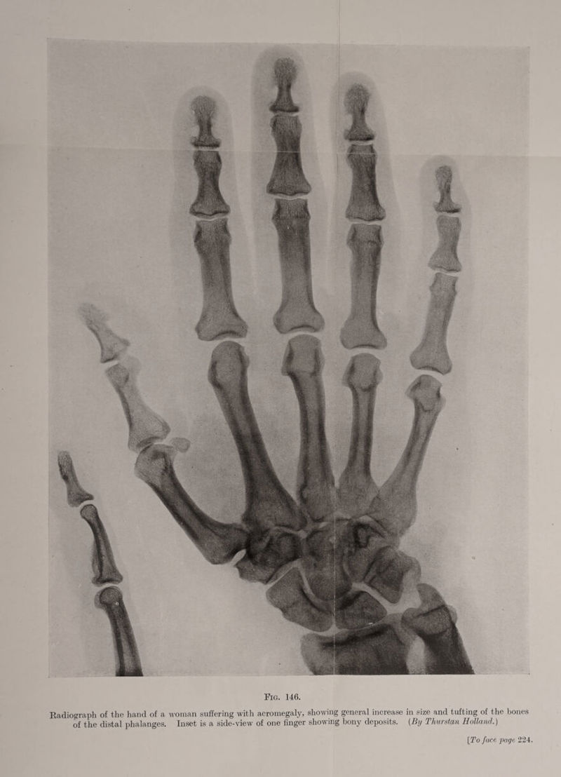 Fig. 146. Kadiograph of the hand of a woman suffering with acromegaly, shoiving general increase in size and tufting of the bones of the distal phalanges. Inset is a side-view of one finger showing bony deposits. (By Thurstan Holland.) [To JaM page 224.