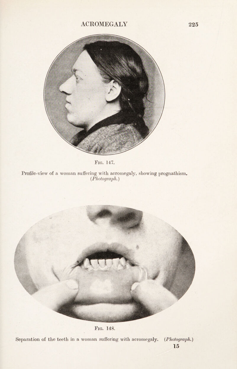Fig. 148. Separation of the teeth in a woman suffering with acromegaly. {Photograph.) 15 Fig. 147. Profile-view of a woman suffering with acromegaly, showing prognathism. {Photograph.)