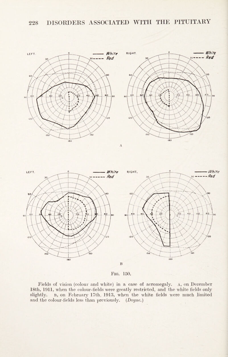 A B Fig. 160. Fields of vision (colour and white) in a case of acromegaly, a, on December 18th,, 1911, when the colour-fields were greatly restricted, and the white fields only slightly. B, on February 17th, 1913, when the white fields were much limited and the colour-fields less than previously. {Doyne.)