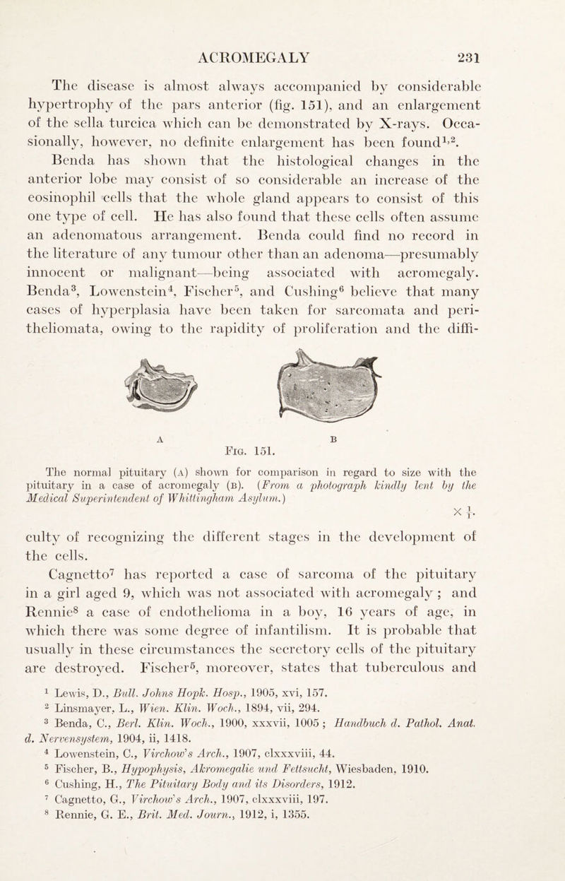 The disease is almost always aeeompanied by considerable hypertrophy of the pars anterior (fig. 151), and an enlargement of the sella turcica which can be demonstrated by X-rays. Occa¬ sionally, however, no definite enlargement has been found Benda has shown that the histological changes in the anterior lobe may consist of so considerable an increase of the eosinophil cells that the whole gland appears to consist of this one type of cell. He has also found that these cells often assume an adenomatous arrangement. Benda could find no record in the literature of any tumour other than an adenoma—presumably innocent or malignant—being associated with acromegaly. Benda^, Lowensteinh Fischer^, and Cushing® believe that many cases of hyperplasia have been taken for sarcomata and peri- theliomata, owing to the rapidity of proliferation and the diffi- A B Fig. 151. The norma] pituitary (a) shown for comparison in regard to size with the pituitary in a case of acromegaly (b). {From a 'photograph kindly lent hy the Medical Superintendent of Whittingham Asylum.) Xf* culty of recognizing the different stages in the development of the cells. Cagnetto'^ has reported a case of sarcoma of the pituitary in a girl aged 9, which was not associated with acromegaly ; and Rennie^ a case of endothelioma in a boy, 16 years of age, in which there was some degree of infantilism. It is probable that usually in these circumstances the secretory cells of the pituitary are destroyed. Fischer^, moreover, states that tuberculous and ^ Lewis, D., Bull. Johns Hopk. Hosp., 1905, xvi, 157. ^ Linsmayer, L., Wien. Klin. Woch., 1894, vii, 294. ^ Benda, C., Berl. Klin. Woch., 1900, xxxvii, 1005 ; Hayidhuch d. Pathol. Anal d. Nervensystem, 1904, ii, 1418. ^ Lowenstein, C., Virchow's Arch., 1907, clxxxviii, 44. ® Fischer, B., Hypophysis, Akromegalie und Fettsucht, Wiesbaden, 1910. ® Cushing, H., The Pituitary Body and its Disorders, 1912. ^ Cagnetto, G., Virchow's Arch., 1907, clxxxviii, 197. ® Bennie, G. E., Brit. Med. Journ., 1912, i, 1355.