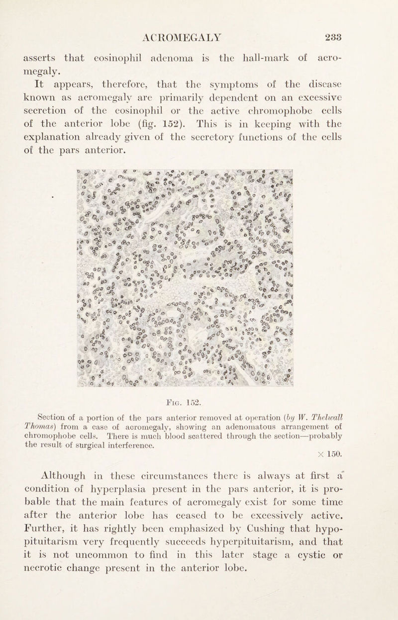 asserts that eosinophil adenoma is the hall-mark of acro¬ megaly. It appears, therefore, that the symptoms of the disease known as aeroinegaly are primarily dependent on an excessive secretion of the eosinophil or the active chromophobe cells of the anterior lobe (fig. 152). This is in keeping with the explanation already given of the secretory functions of the cells of the pars anterior. , a '*• ■ ® f e <& ft v- «a « o ® 19 * ‘i # ‘ <2^ a. «3o o o & .(? - {o ,© o 'i'o <9 . orS4Q^%^ % & O'- ^ ft ® «? . c-^ ■» <#© © ^ : G X t -A® O o ' <3 ® * ® ® ® ' >) i> A r. fy 9 A ® ' ■ ^ ® ^ ^ s> ^ n A- w ©£?, 4 '8 ® ^ .Oti’ ® © «>><? 650 ^<65 s' ol| td>0 fl ® 0 ^ '<.1 W A n ^ o'-’ ® % 0 ^ 0® 0’<@> '.SP ® S ® S(5^ 1? 9 O (? b © >2 (S>® O ^ *  <5 -^' iy . ■ „1.J9 ^ Cs. f A© , >V ® <3© <9 d S<J; , <=© ^ Q < 8VA>A» *o| ' . b4 ©4v ^ ^ i>© ® Q§a^-Q % %l% .A 0®©^. ■ <= ', ■&£> ^ e ^ O.. ^v;0 ® « G - 0^ fii §5 .. ' 0;#8. '.-l i- ^ A*-''4 fi ® ' £9®' ‘ a ® % % ° -£> ®tf >© Fig. 152. Section of a portion of the pars anterior removed at operation [by W. Thelwall Thomas) from a case of acromegaly, showing an adenomatous arrangement of chromophobe cells. There is much blood scattered through the section—probably the result of surgical interference. X 150. Although in these circumstances there is always at first a condition of hyperplasia present in the pars anterior, it is pro¬ bable that the main features of acromegaly exist for some time after the anterior lobe has ceased to be excessively active. Further, it has rightly been emphasized by Cushing that hypo¬ pituitarism very frequently succeeds hyperpituitarism, and that it is not uncommon to find in this later stage a cystic or necrotic change present in the anterior lobe.
