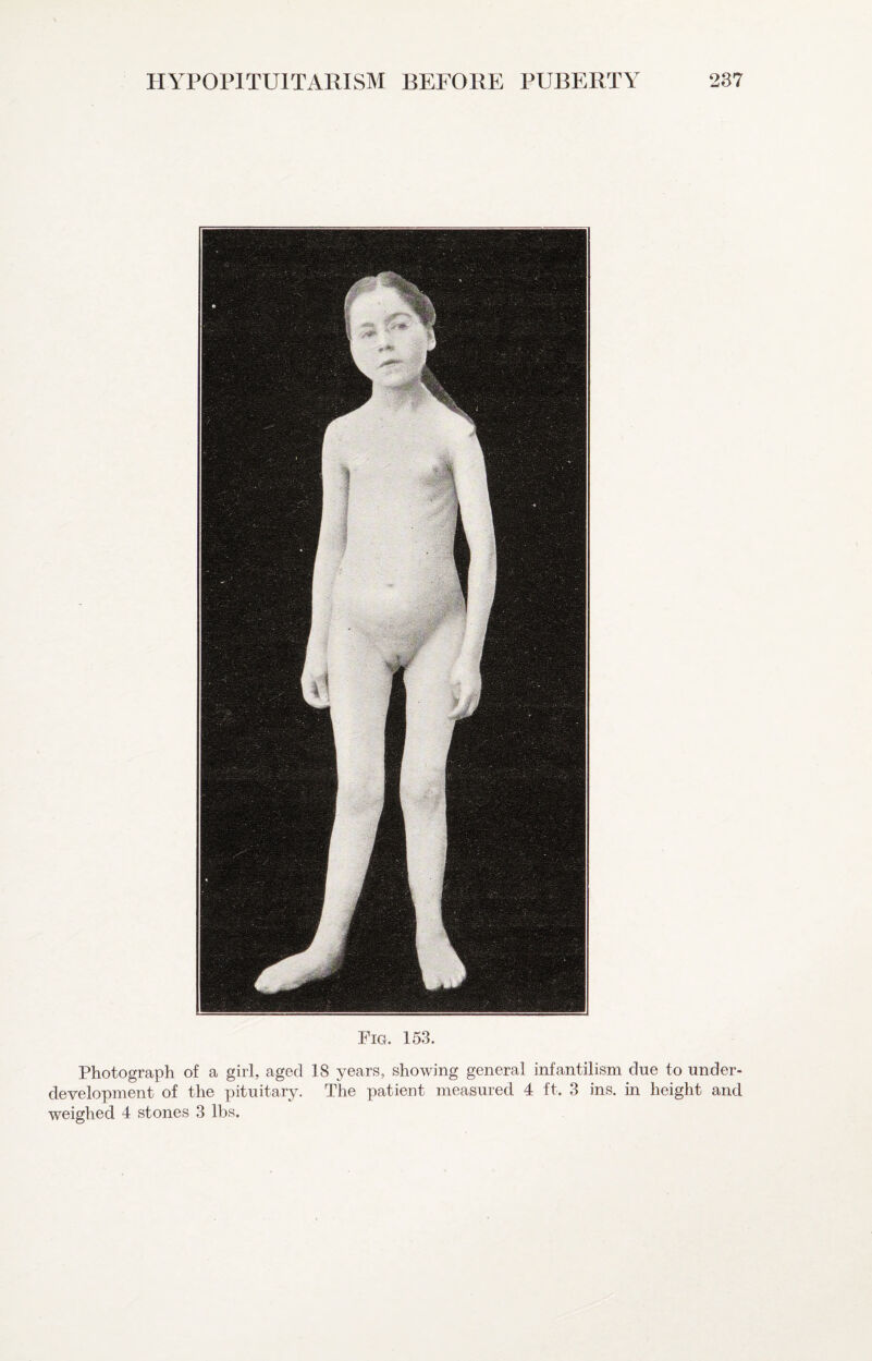 Fig. 153. Photograph of a girl, aged 18 years, showing general infantilism clue to under¬ development of the pituitary. The patient measured 4 ft. 3 ins. in height and weighed 4 stones 3 lbs.