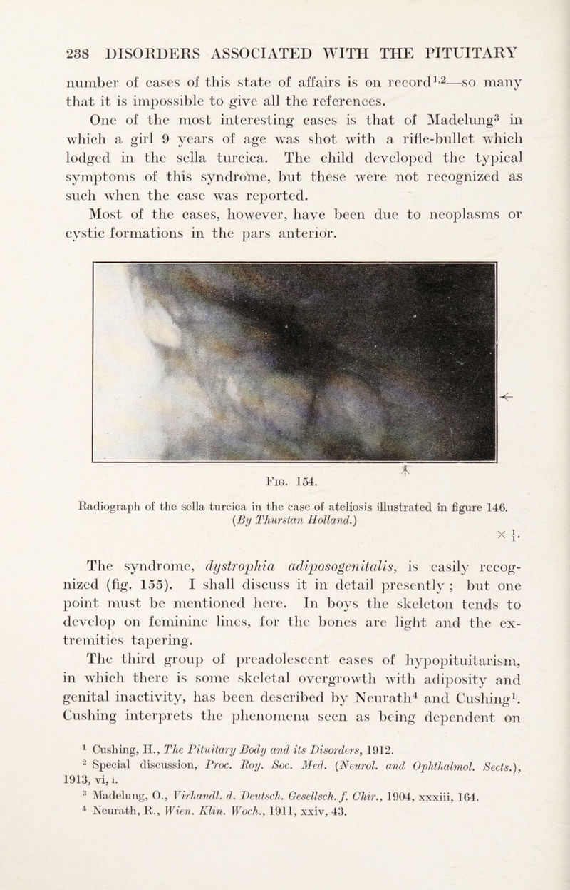 number of cases of this state of affairs is on record ^>2—go many that it is impossible to give all the references. One of the most interesting cases is that of Madelung^ in which a girl 9 years of age was shot with a rifle-bullet which lodged in the sella turcica. The child developed the typical symptoms of this syndrome, but these were not recognized as such when the case was reported. Most of the cases, however, have been due to neoplasms or cystic formations in the pars anterior. Radiograph of the sella turcica in the case of ateliosis illustrated in figure 146. {By Thurstan Holland.) The syndrome, dystrophia adiposogenitalis, is easily recog¬ nized (fig. 155). I shall discuss it in detail presently ; but one point must be mentioned here. In boys the skeleton tends to develop on feminine lines, for the bones are light and the ex¬ tremities tapering. The third group of preadoleseent cases of hypopituitarism, in which there is some skeletal overgrowth with adiposity and genital inactivity, has been described by Neurath^ and Cushing^. Cushing interprets the phenomena seen as being dependent on ^ Cushing, H., The Pituitary Body and its Disorders^ 1912. Special discussion, Proc. Roy. Soc. Med. {Neurol, and Ophthalmol. Sects.), 1913, vi, i. 2 Madelung, 0., Virhandl. d. Deutsch. Oesellsch.f. Chir., 1904, xxxiii, 164, ^ Neurath, R., Wien. Klin. Woch., 1911, xxiv, 43.