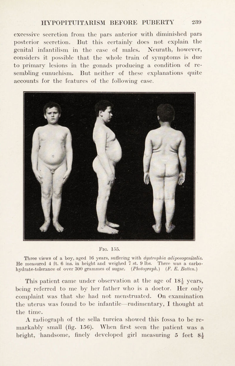 excessive secretion from the pars anterior with diminished pars posterior secretion. But this certainly does not explain the genital infantilism in the case of males. Neurath, however, considers it possible that the whole train of symptoms is due to primary lesions in the gonads producing a condition of re- sembling eunuchism. But neither of these explanations quite accounts for the features of the following case. Fig. 155. Three views of a boy, aged 16 years, suffering with dystrophia adiposogenitalis. He measured 4 ft. 6 ins. in height and weighed 7 st. 9 lbs. There was a carbo¬ hydrate-tolerance of over 300 grammes of sugar. {Photograph.) {F. E. Batten.) This patient came under observation at the age of 18J years, being referred to me by her father who is a doctor. Her only complaint was that she had not menstruated. On examination the uterus was found to be infantile—rudimentary, I thought at the time. A radiograph of the sella turcica showed this fossa to be re¬ markably small (fig. 156). When first seen the patient was a bright, handsome, finely developed girl measuring 5 feet 8j