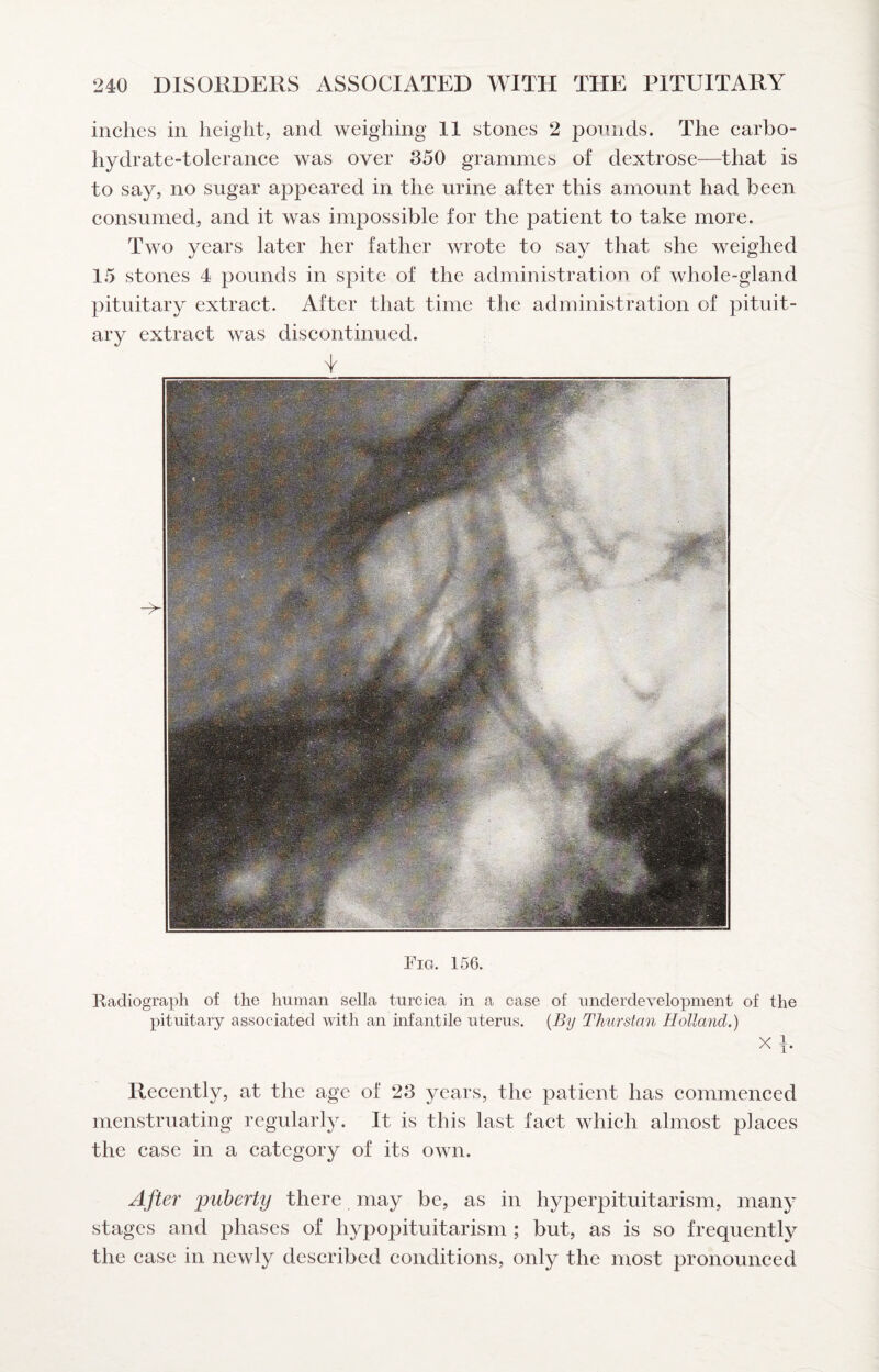 inches in height, and weighing 11 stones 2 pounds. The carbo¬ hydrate-tolerance was over 350 grammes of dextrose—that is to say, no sugar appeared in the urine after this amount had been consumed, and it was impossible for the patient to take more. Two years later her father wrote to say that she weighed 15 stones 4 pounds in spite of the administration of whole-gland pituitary extract. After that time the administration of pituit¬ ary extract was discontinued. Fig. 156. Radiograph of the human sella turcica in a case of underdevelopment of the pituitary associated with an infantile uterus. {By Thurstan Holland.) X b Recently, at the age of 23 years, the patient has commenced menstruating regularly. It is this last fact which almost places the case in a category of its own. After 'puberty there may be, as in hyperpituitarism, many stages and phases of hypopituitarism ; but, as is so frequently the case in newly described conditions, only the most pronounced