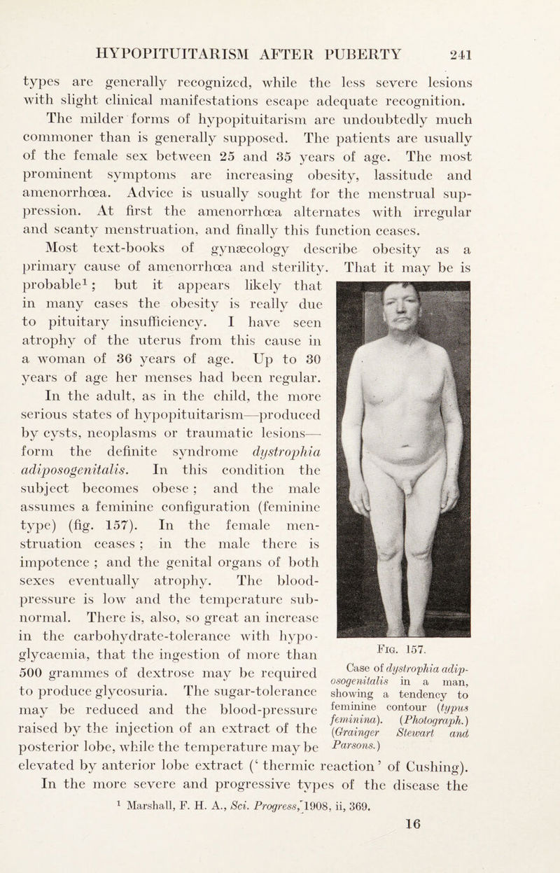 types are generally recognized, while the less severe lesions with slight clinical manifestations escape adequate recognition. The milder forms of hypopituitarism are undoubtedly much commoner than is generally supposed. The patients are usually of the female sex between 25 and 35 years of age. The most prominent symptoms are increasing obesity, lassitude and amenorrhoea. Advice is usually sought for the menstrual sup- pression. At first the amenorrhoea alternates with irregular and scanty menstruation, and finally this function ceases. Most text-books of gynaecology describe obesity as a primary cause of amenorrhoea and sterility. That it may be is probable 1; but it appears likely that in many cases the obesity is really due to pituitary insufficiency. I have seen atrophy of the uterus from this cause in a woman of 36 years of age. Up to 30 years of age her menses had been regular. In the adult, as in the child, the more serious states of hypopituitarism—produced by cysts, neoplasms or traumatic lesions— form the definite syndrome dystrophia adiposogenitalis. In this condition the subject becomes obese ; and the male assumes a feminine configuration (feminine type) (fig. 157). In the female men¬ struation ceases ; in the male there is impotence ; and the genital organs of both sexes eventually atrophy. The blood- pressure is low and the temperature sub¬ normal. There is, also, so great an increase in the carbohydrate-tolerance with hypo- glycaemia, that the ingestion of more than 500 grammes of dextrose may be required dystrophia adip- . 1 osogemiahs m a man, to produce glycosuria. The sugar-tolerance showing a tendency to may be reduced and the blood-pressure kmimne contour {typus -,1 .P.1 fem.inina). {Photograph.) raised by the injection of an extract of the {Grainger Stewart and posterior lobe, while the temperature may be Parsons.) elevated by anterior lobe extract (‘ thermic reaction’ of Cushing). In the more severe and progressive types of the disease the 1 Marshall, F. H. A., Sci. Progress1^0^, ii, 369. Fig. 157. 16