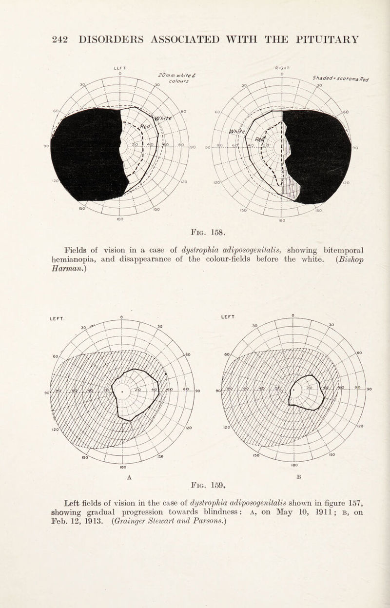 LEFT RIGHT 180 igQ Fig. 158. Fields of vision in a case of dystrophia adiposogenitalis, showing bitemporal hemianopia, and disappearance of the colour-fields before the white. [Bishop Harman.) A B Fig. 159, Left fields of vision in the case of dystrophia adiposogenitalis shown in figure 157, showing gradual progression towards blindness: a, on May 10, 1911; B, on Feb. 12, 1913. [Grainger Stewart and Parsons.)