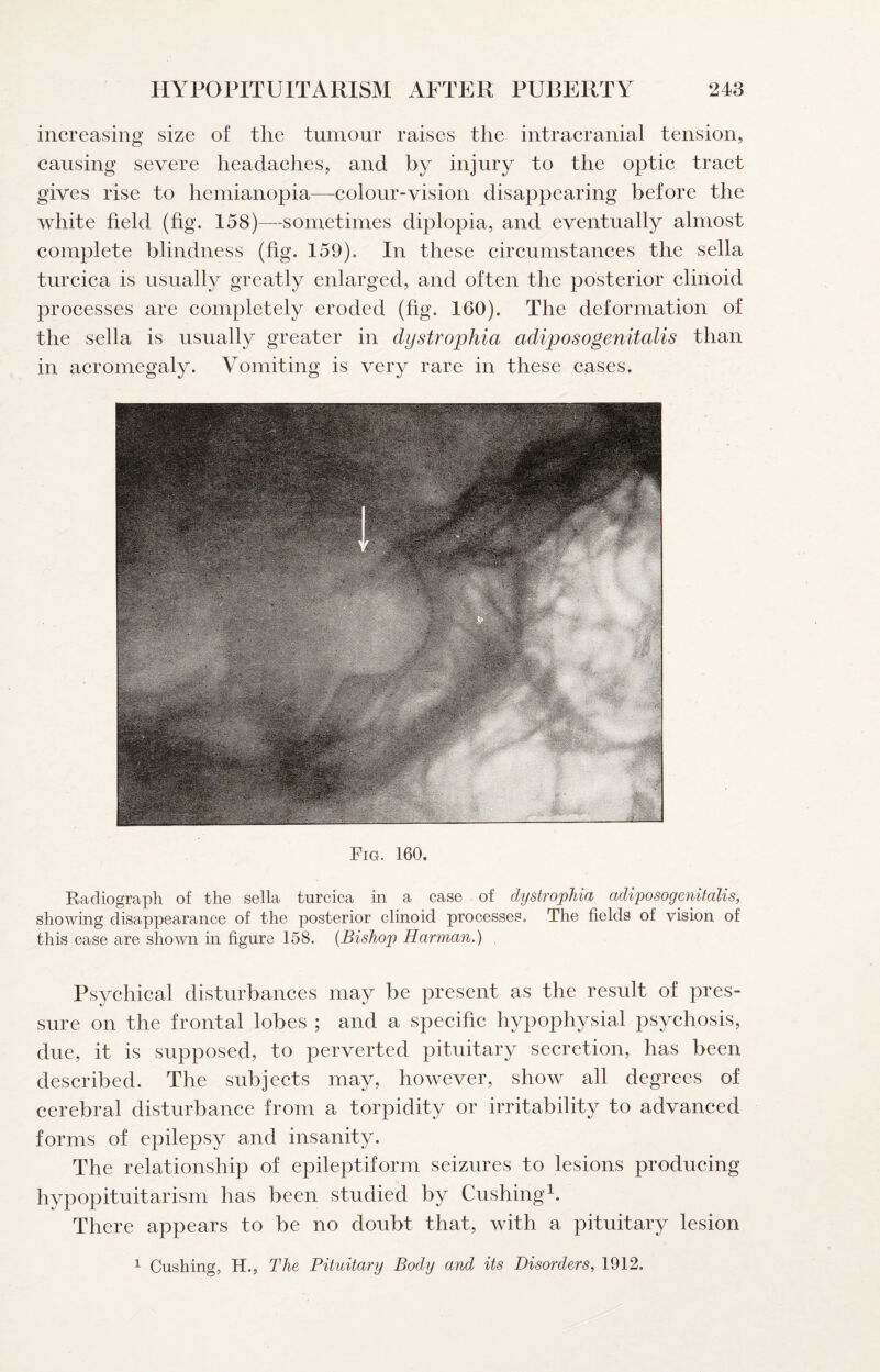increasing size of the tumour raises the intracranial tension, causing severe headaches, and by injury to the optic tract gives rise to heinianopia—colour-vision disappearing before the white field (fig. 158)—sometimes diplopia, and eventually almost complete blindness (fig. 159), In these circumstances the sella turcica is usually greatly enlarged, and often the posterior clinoid processes are completely eroded (fig. 160). The deformation of the sella is usually greater in dystrophia adiposogenitalis than in acromegaly. Vomiting is very rare in these cases. Fig. 160. Radiograph of the sella turcica in a case of dystrophia adiposogenitalis, showing disappearance of the posterior clinoid processes. The fields of vision of this case are shown in figure 158. {Bishop Harman.) Psychical disturbances may be present as the result of pres¬ sure on the frontal lobes ; and a specific hypophysial psychosis, due, it is supposed, to perverted pituitary seeretion, has been described. The subjects may, however, show all degrees of cerebral disturbance from a torpidity or irritability to advanced forms of epilepsy and insanity. The relationship of epileptiform seizures to lesions producing hypopituitarism has been studied by Cushing^. There appears to be no doubt that, with a pituitary lesion