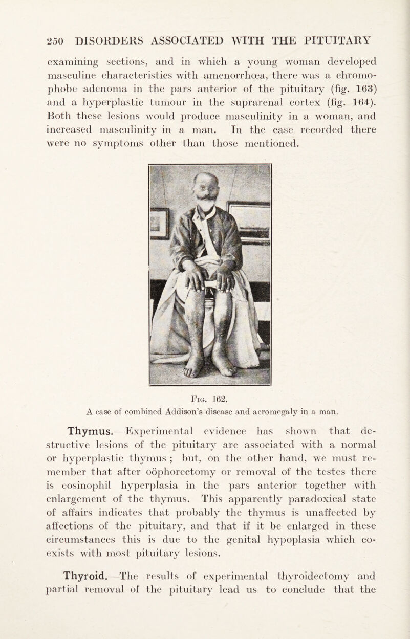 examining sections, and in which a young woman developed masculine characteristics with amenorrhoea, there was a chromo¬ phobe adenoma in the pars anterior of the pituitary (fig. 163) and a hyperplastic tumour in the suprarenal cortex (fig. 164). Both these lesions would produce masculinity in a woman, and increased masculinity in a man. In the case recorded there were no symptoms other than those mentioned. Fig. 162. A case of combined Addison’s disease and acromegaly in a man. Thymus.—Experimental evidence has shown that de¬ structive lesions of the pituitary are associated with a normal or hyperplastic thymus ; but, on the other hand, we must re¬ member that after oophorectomy or removal of the testes there is eosinophil hyperplasia in the pars anterior together with enlargement of the thymus. This apparently paradoxical state of affairs indicates that probably the thymus is unaffected by affections of the pituitary, and that if it be enlarged in these circumstances this is due to the genital hypoplasia which co¬ exists with most pituitary lesions. Thyroid.- -The results of experimental thyroidectomy and partial removal of the pituitary lead us to conclude that the