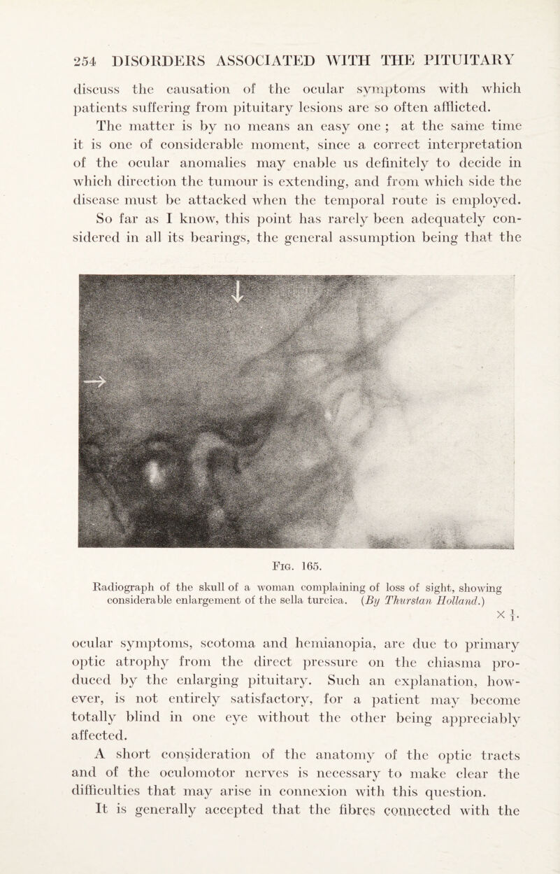 discuss the causation of the ocular symptoms with which patients suffering from pituitary lesions are so often afflicted. The matter is by no means an easy one ; at the same time it is one of considerable moment, since a correct interpretation of the ocular anomalies may enable us definitely to decide in which direction the tumour is extending, and from which side the disease must be attacked when the temporal route is employed. So far as I know, this point has rarely been adequately con¬ sidered in all its bearings, the general assumption being that the Fig. 165. Radiograph of the skull of a woman complaining of loss of sight, showing considerable enlargement of the sella turcica. {By Thurstan Holland.) X 1. ocular symptoms, scotoma and hemianopia, are due to primary optic atrophy from the direct pressure on the chiasma pro¬ duced by the enlarging pituitary. Such an explanation, how¬ ever, is not entirely satisfactory, for a patient may become totally blind in one eye without the other being appreciably affected. A short consideration of the anatomy of the optic tracts and of the oculomotor nerves is necessary to make clear the difficulties that may arise in connexion with this question. It is generally accepted that the fibres connected with the