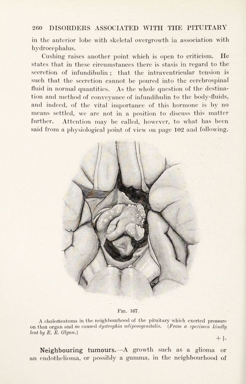 in the anterior lobe with skeletal overgrowth in association with hydrocephalus. Cushing raises another point which is open to criticism. He states that in these circumstances there is stasis in regard to the secretion of infundibulin ; that the intraventricular tension is such that the secretion cannot be poured into the cerebrospinal fluid in normal quantities. As the whole question of the destina¬ tion and method of conveyance of infundibulin to the body-fluids, and indeed, of the vital importance of this hormone is by no means settled, we are not in a position to discuss this matter further. Attention may be called, however, to what has been said from a physiological point of view on page 102 and following. Fig. 167. A cholesteatoma in the neighbourhood of the pituitary which exerted pressure on that organ and so caused dystrophia adiposogenitalis. {From a specimen kindly lent by E. E. Glynn.) 4- 1 I 1 • Neighbouring tumours.—A growth such as a glioma or an endothelioma, or possibly a gumma, in the neighbourhood of
