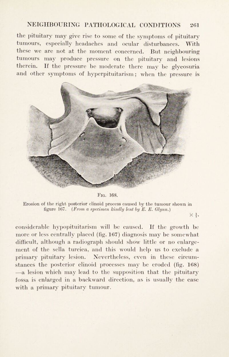 the pituitary may give rise to some of the symptoms of pituitary tumours, espeeially headaches and ocular disturbances. With these we are not at the moment concerned. But neighbouring tumours may produce pressure on the pituitary and lesions therein. If the pressure be moderate there may be glycosuria and other symptoms of hyperpituitarism; when the pressure is Fig. 168. Erosion of the right posterior clinoid process caused by the tumour shown in figure 167. {From a specimen kindly lent hy E. E. Glynn.) X 1 1' considerable hypopituitarism will be caused. If the growth be more or less centrally placed (fig. 167) diagnosis may be somewhat difficult, although a radiograph should show little or no enlarge¬ ment of the sella turcica, and this would help us to exclude a primary pituitary lesion. Nevertheless, even in these circum¬ stances the posterior clinoid processes may be eroded (fig. 168) —a lesion which may lead to the supposition that the pituitary fossa is enlarged in a backward direction, as is usually the case with a primary pituitary tumour.