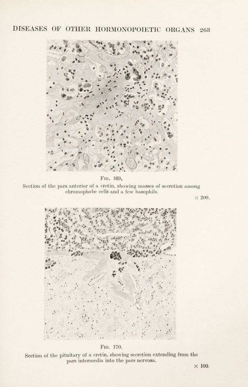 ' X ' X i%o y ^ , I /. i •'#' 5% O T » x;a: , ■.'*-. j #a • , - 6P* 10 m **-X ®' X***' * •■• .- -Vk- •.'- <k .«G« ' , X , . . 4' ^%\\ • ■ i C? -i ■ ’-I , • © , .% t£|;Tv® J s '*®®* * ,.X •4 67 ® <** » V o'* . ‘ ^i#-■ •' - ® « ,vJi& - /l ''V' 0 o i/ I«» ' i - » 1%. - 0 e> ^ t 0 0^ S o o e j,- ^ * CJ , - .■r^^ *B t- Q ' I / -'■k^ s a e. . W ' X^' - « ■6'’ ' '*• L ) / ’- ^. t A V . ^ - ^ 4^. I ' (2; Y' tf*. I / ' ^ ' ^ ^ » „ '1 •• - .& e> 4, ^ . CP* e> £ ( i»i , y /liO ) < 8 .' i» . if ■ X ^ ■ ' ■ ,T * ■ ^ , ««» e , ;i'^. I ;»•■' ^‘'’\ ' 1 tt'''X'-V‘A . „ -y’''X.'> ,'v,' -* XX # y*9“ , i ■\:^- A ^ ^ X 43 So *'S Pi Fia. 169. Section of the pars anterior of a cretin, showing masses of secretion among chromophobe cells and a few basophils. X 200. Fig. 170. Section of the pituitary of a cretin, showing secretion extending from the pars intermedia into the pars nervosa.