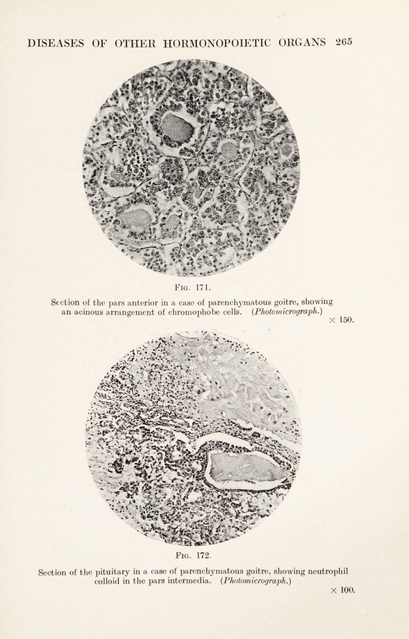 Fig. 171. Section of the pars anterior in a case of parenchymatous goitre, showing an acinous arrangement of chromophobe cells. {Photomicrograph.) X 150. Fig. 172. Section of the pituitary in a case of parenchymatous goitre, showing neutrophil colloid in the pars intermedia. {Photomicrograph.)