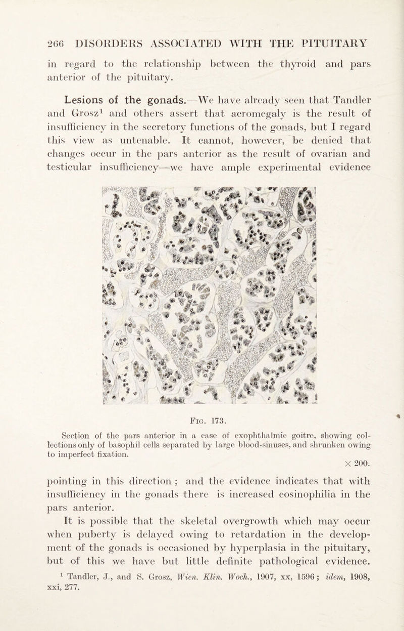 in regard to the relationship between the thyroid and pars anterior of the pituitary. Lesions of the gonads.—We have already seen that Tandler and Grosz^ and others assert that aeromegaly is the result of insufficieney in the seeretory funetions of the gonads, but I regard this view as untenable. It cannot, however, be denied that changes occur in the pars anterior as the result of ovarian and testicular insufficiency^—we have ample experimental evidence Fig. 173. Section of the pars anterior in a case of exophthalmic goitre, showing col¬ lections only of basophil cells separated by large blood-sinuses, and shrunken owing to imperfect fixation. X 200. pointing in this direction ; and the evidence indicates that with insufficiency in the gonads there is increased eosinophilia in the pars anterior. It is possible that the skeletal overgrowth which may occur when puberty is delayed owing to retardation in the develop¬ ment of the gonads is occasioned by hyperplasia in the pituitary, but of this we have but little definite pathological evidence. ^ Tandler, J., and S. Grosz, Wien. Klin. Woch., 1907, xx, 1696; idem^ 1908, xxi, 277.