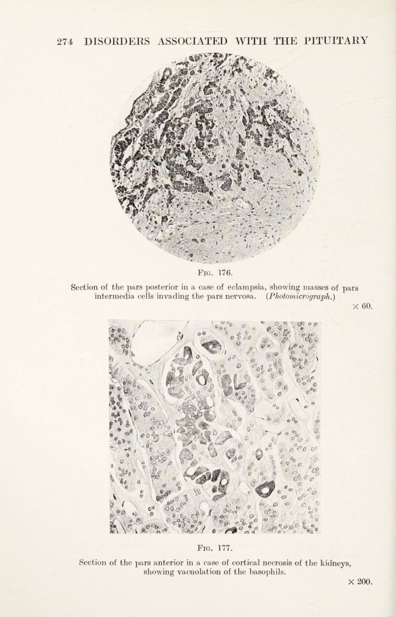 Fig. 176. Section of the pars posterior in a case of eclampsia, showing masses of pars intermedia cells invading the pars nervosa. {Photomicrograph.) X 60 - fV'’' //a <• fe'.“ '»■ r W' A - 0 A' V.. 0 ' ' * - feS aVv,:’ffe4 % '^' o , > '© © '© > »s> t.% A 'I ^ ^ 3 ■# ^ :-® ® 1^0%'^ f«AiP- O’ /-• e>'-^ ^ ^ ^ ‘o.TA ^ 5 — r'(^. fo., 0 3- ...3^00 3 vY'Ai3 J I 'A m i j-l.j2>f0r _s' m ^ ^ «5 ® ■ ® V. ■ ,c® ^ f 1'3 I X r t,0'®  .&. °« ■ ^ ■ \ 6® ©S/# ' ■* V Jp ® -v' WVGf •■ #7x3 ®<Sf^ ' ^ , •« K ®elfe® ®0 ., fo e ^ \ 1AV A •>> .ft •^' . V / 0 /®P a ' y /<? '•' * Fig. 177. Section of the pars anterior in a case of cortical necrosis of the kidneys, showing vacuolation of the basophils. X 200