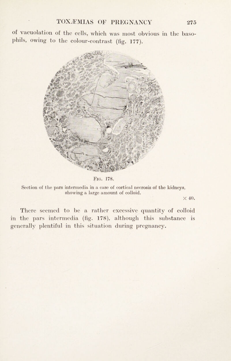 of vacuolation of the cells, which was most obvious in the baso¬ phils, owing to the colour-contrast (fig. 177). Fig. 178. Section of the pars intermedia in a case of cortical necrosis of the kidneys, showing a large amount of colloid. X 40. There seemed to be a rather excessive quantity of colloid in the pars intermedia (fig. 178), although this substance is generally plentiful in this situation during pregnancy.