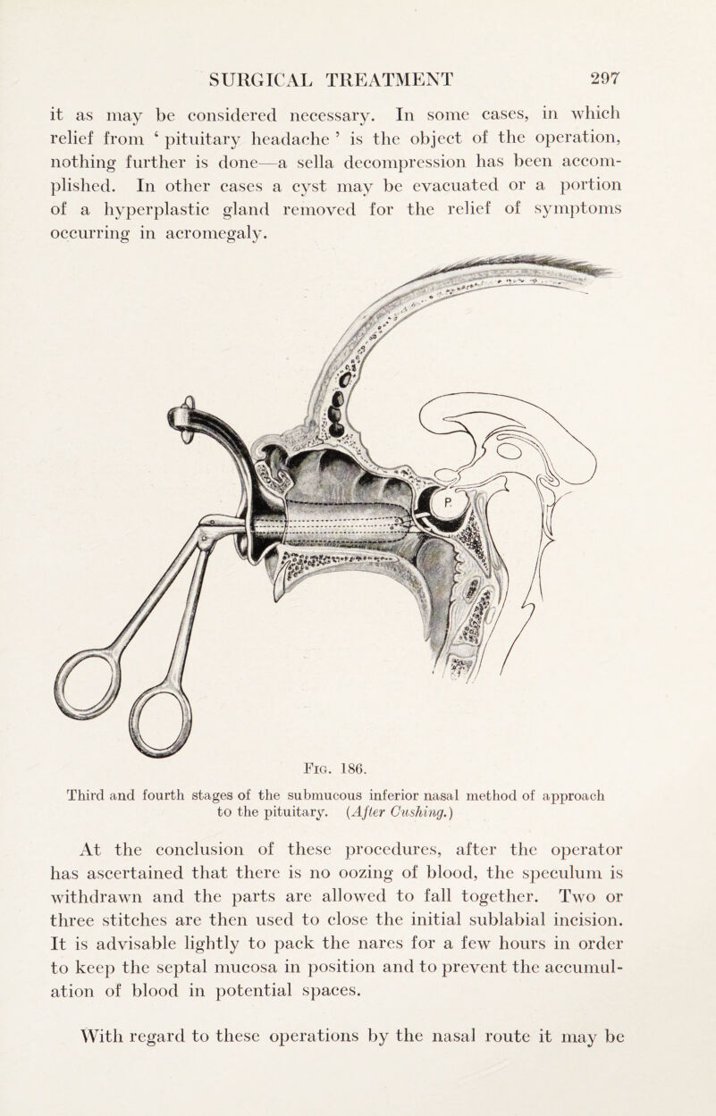 it as may be considered necessary. In some cases, in which relief from ‘ pituitary headache ’ is the object of the operation, nothing further is done—a sella decompression has been accom¬ plished. In other cases a cyst may be evacuated or a portion of a hyperplastic gland removed for the relief of symptoms occurring in acromegaly. Fig. 186. Third and fourth stages of the submucous inferior nasal method of approach to the pituitary. {After Gushing.) At the conclusion of these procedures, after the operator has ascertained that there is no oozing of blood, the speculum is withdrawn and the parts are allowed to fall together. Two or three stitches are then used to close the initial sublabial incision. It is advisable lightly to pack the nares for a few hours in order to keep the septal mucosa in position and to prevent the accumul¬ ation of blood in potential spaces. With regard to these operations by the nasal route it may be