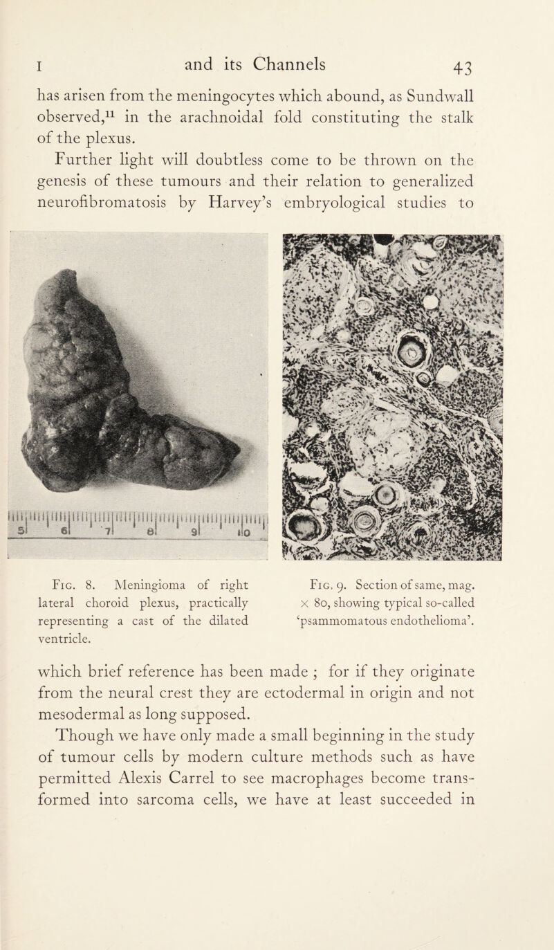 has arisen from the meningocytes which abound, as Sundwall observed,11 in the arachnoidal fold constituting the stalk of the plexus. Further light will doubtless come to be thrown on the genesis of these tumours and their relation to generalized neurofibromatosis by Harvey’s Fig. 8. Meningioma of right lateral choroid plexus, practically representing a cast of the dilated ventricle. embryological studies to Fig. 9. Section of same, mag. X 80, showing typical so-called ‘psammomatous endothelioma’. which brief reference has been made ; for if they originate from the neural crest they are ectodermal in origin and not mesodermal as long supposed. Though we have only made a small beginning in the study of tumour cells by modern culture methods such as have permitted Alexis Carrel to see macrophages become trans¬ formed into sarcoma cells, we have at least succeeded in