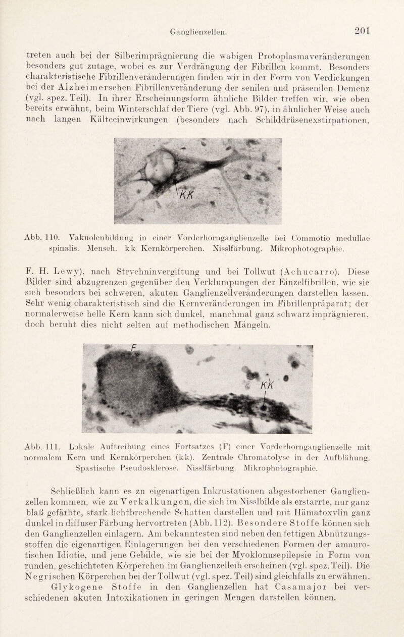 treten auch bei der Silberimprägnierung die wabigen Protoplasmaveränderungen besonders gut zutage, wobei es zur Verdrängung der Fibrillen kommt. Besonders charakteristische Fibrillenveränderungen finden wir in der Form von Verdickungen bei der Alz heim ersehen Fibrillenveränderung der senilen und präsenilen Demenz (vgl. spez. Teil). In ihrer Erscheinungsform ähnliche Bilder treffen wir, wie oben bereits erwähnt, beim Winterschlaf der Tiere (vgl. Abb. 97), in ähnlicher Weise auch nach langen Kälteeinwirkungen (besonders nach Schilddrüsenexstirpationen, Abb. 110. Vakuolenbildung in einer Vorderhornganglienzelle bei Coniniotio medullae spinalis. Mensch, kk Kernkörperchen. Nisslfärbung. Mikrophotographie. F. H. L ewy), nach Strychninvergiftnng und bei Tollwut (Achucarro). Diese Bilder sind abzugrenzen gegenüber den Verklumpungen der Einzelfibrillen, wie sie sich besonders bei schweren, akuten Ganglienzellveränderungen darstellen lassen. Sehr wenig charakteristisch sind die Kernveränderungen im Fibrillenpräparat; der normalerweise helle Kern kann sich dunkel, manchmal ganz schwarz imprägnieren, doch beruht dies nicht selten auf methodischen Mängeln. Abb. 111. Lokale Auftreibung eines Fortsatzes (F) einer Vorderhornganglienzelle mit normalem Kern und Kernkörperchen (kk). Zentrale Chromatolyse in der Aufblähung. Spastische Pseudosklerose. Kisslfärbung. Mikrophotographie. Schließlich kann es zu eigenartigen Inkrustationen abgestorbener Ganglien¬ zellen kommen, wie zu Verkalkungen, die sich im Nisslbilde als erstarrte, nur ganz blaß gefärbte, stark lichtbrechende Schatten darstellen und mit Hämatoxylin ganz dunkel in diffuser Färbung hervortreten (Abb. 112). Besondere Stoffe können sich den Ganglienzellen einlagern. Am bekanntesten sind neben den fettigen Abnützungs¬ stoffen die eigenartigen Einlagerungen bei den verschiedenen Formen der amauro¬ tischen Idiotie, und jene Gebilde, wie sie bei der Myoklonusepilepsie in Form von runden, geschichteten Körperchen im Ganglienzelleib erscheinen (vgl. spez. Teil). Die Negrischen Körperchen bei der Tollwut (vgl. spez. Teil) sind gleichfalls zu erwähnen. Glykogene Stoffe in den Ganglienzellen hat Casamajor bei ver¬ schiedenen akuten Intoxikationen in geringen Mengen darstellen können.