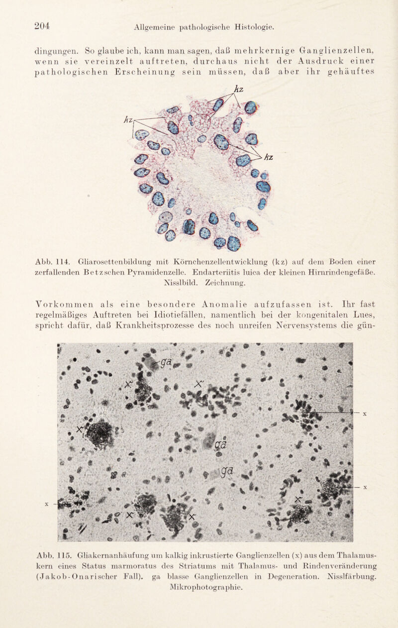 Abb. 115. Gliakernanhäiifung um kalkig inkrustierte Ganglienzellen (x) aus dem Thalanius- kern eines Status marmoratus des Striatums mit Thalamus- und Rindenveränderung (Jakob-Onarischer Fall), ga blasse Ganglienzellen in Degeneration. Nisslfärbung. Mikrophotographie. Abb. 114. Gliarosettenbildimg mit Körnchenzellentwicklung (kz) auf dem Boden einer zerfallenden Betzschen Pyramidenzelle. Endarteriitis luica der kleinen Hirnrindengefäße. Nisslbild. Zeichnung. Vorkommen als eine besondere Anomalie aufziifassen ist. Ihr fast regelmäßiges Auftreten bei Idiotiefällen, namentlich bei der kongenitalen Lues, spricht dafür, daß Krankheitsprozesse des noch unreifen Nervensystems die gün- dingungen. So glaube ich, kann man sagen, daß mehr kernige Ganglienzellen, wenn sie vereinzelt anftreten, durchaus nicht der A^nsdruck einer pathologischen Erscheinung sein müssen, daß aber ihr gehäuftes