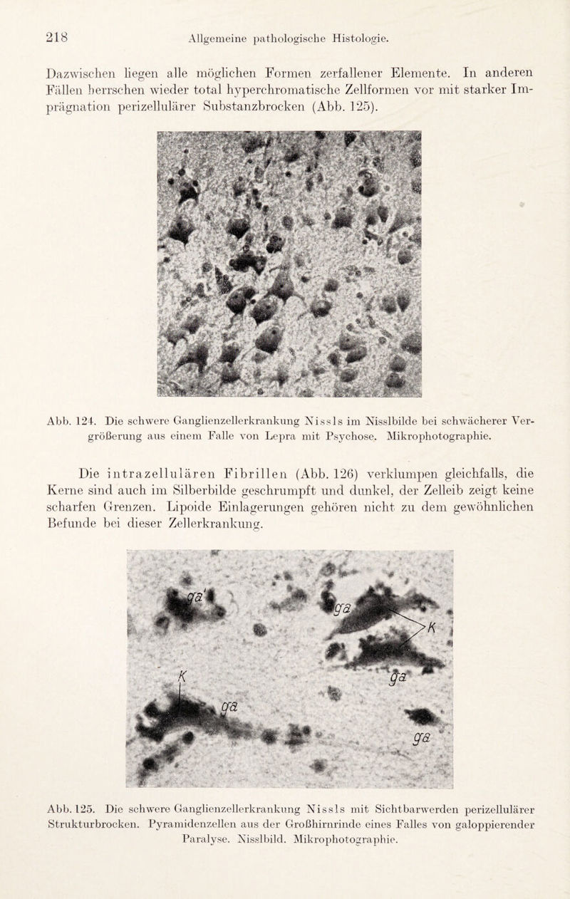 Dazwischen liegen alle mögliclien Formen zerfallener Elemente. In anderen Fällen herrschen wieder total hyperchromatische Zellformen vor mit starker Im¬ prägnation perizellulärer Siibstanzbrocken (Abb. 125). Abb. 124. Die schwere Ganglienzellerkrankung Nissls im Nisslbilde bei schwächerer Ver¬ größerung aus einem Falle von Lepra mit Psychose. Mikrophotographie. Die intrazellulären Fibrillen (Abb. 126) verklumpen gleichfalls, die Kerne sind auch im Silberbilde geschrumpft und dunkel, der Zelleib zeigt keine scharfen Grenzen. Lipoide Einlagerungen gehöreii nicht zu dem gewöhnlichen Befunde bei dieser Zellerkrankung. Abb. 125. Die schwere Ganglienzellerkrankung Nissls mit Sichtbarwerden perizellulärer Strukturbrocken. Pyramidenzellen aus der Großhirnrinde eines Falles von galoppierender Paralyse. Nisslbild. Mikrophotographie.