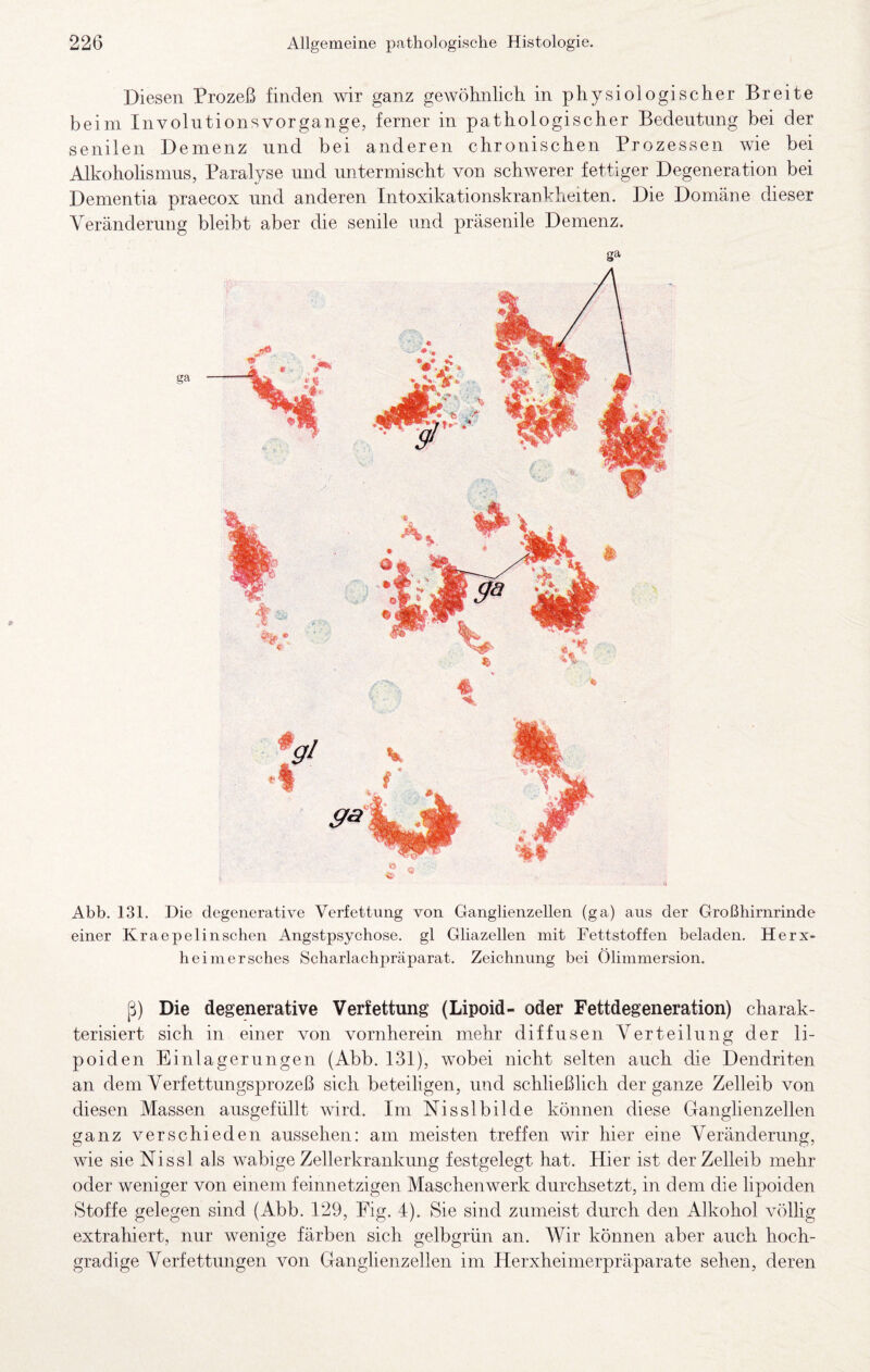 Diesen Prozeß finden wir ganz gewöhnlich in physiologischer Breite beim Involntionsvorgange, ferner in pathologischer Bedeutung bei der senilen Demenz und bei anderen chronischen Prozessen wie bei Alkoholismns, Paralyse und untermischt von schwerer fettiger Degeneration bei Dementia praecox und anderen Intoxikationskrankheiten. Die Domäne dieser Veränderung bleibt aber die senile und präsenile Demenz. Abb. 131. Die degeiierative Verfettung von Ganglienzellen (ga) aus der Großhirnrinde einer Kraepelinsehen Angstpsychose, gl Gliazellen mit Fettstoffen beladen. Herx- heimersches Scharlachpräparat. Zeichnung bei Olimmersion. ß) Die degenerative Verfettung (Lipoid- oder Fettdegeneration) charak¬ terisiert sich in einer von vornherein mehr diffusen Verteilung der li- poiden Einlagerungen (Abb. 131), wobei nicht selten auch die Dendriten an dem Verfettungsprozeß sich beteiligen, und schließlich der ganze Zelleib von diesen Massen ausgefiillt wird. Im Nisslbilde können diese Ganglienzellen ganz verschieden aussehen: am meisten treffen wir hier eine Veränderung, wie sie Nissl als wabige Zellerkranknng festgelegt hat. Hier ist der Zelleib mehr oder weniger von einem feinnetzigen Maschenwerk durchsetzt, in dem die lipoiden Stoffe gelegen sind (Abb. 129, Fig. 4). Sie sind zumeist durch den Alkohol völlig extrahiert, nur wenige färben sich gelbgrün an. Wir können aber auch hoch¬ gradige Verfettungen von Ganglienzellen im Herxheinierpräparate sehen, deren