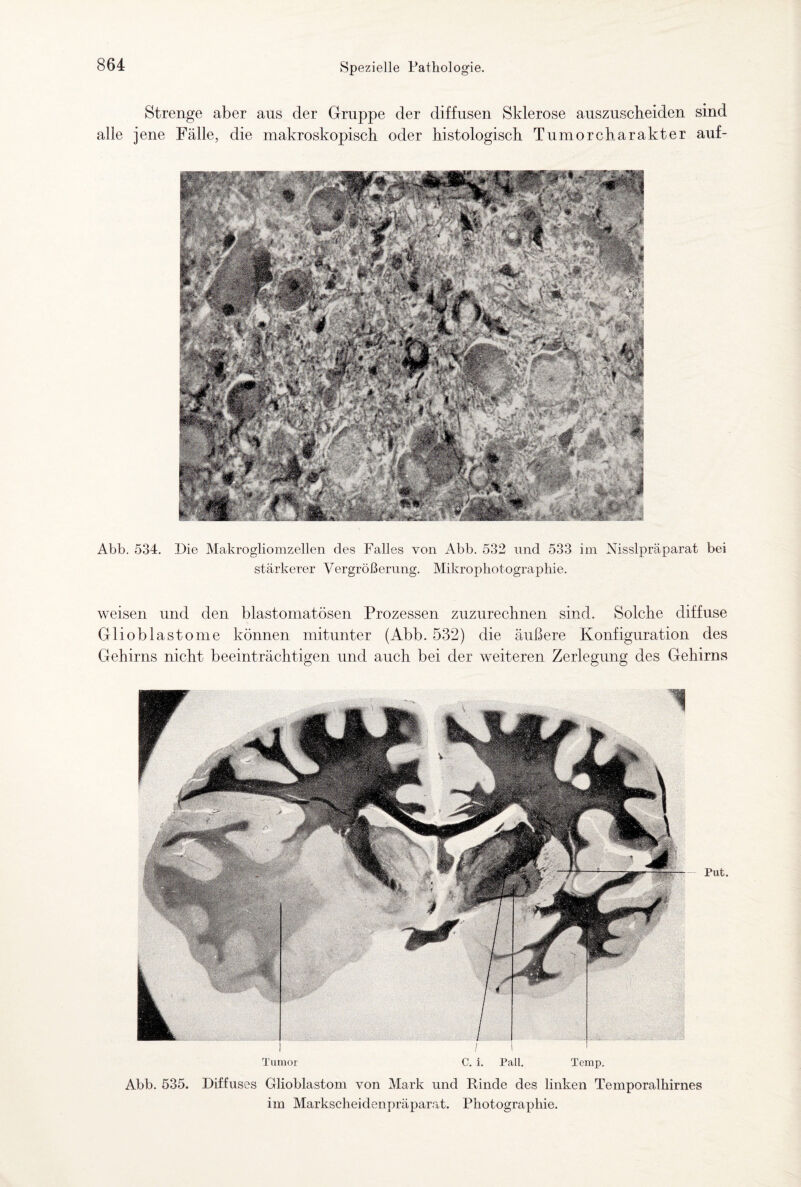 Strenge aber aus der Gruppe der diffusen Sklerose auszuscheiden sind alle jene Fälle, die makroskopisch oder histologisch Tumorcharakter auf- Abb. 534. Die Makrogliomzellen des Falles von Abb. 532 und 533 im Nisslpräparat bei stärkerer Vergrößerung. Mikrophotographie. weisen und den blastomatösen Prozessen zuzurechnen sind. Solche diffuse Glioblastome können mitunter (Abb. 532) die äußere Konfiguration des Gehirns nicht beeinträchtigen und auch bei der weiteren Zerlegung des Gehirns Tumor C. i. Pall. Temp. Abb. 535. Diffuses Glioblastom von Mark und Rinde des linken Temporalhirnes im Markscheidenpräparat. Photographie.