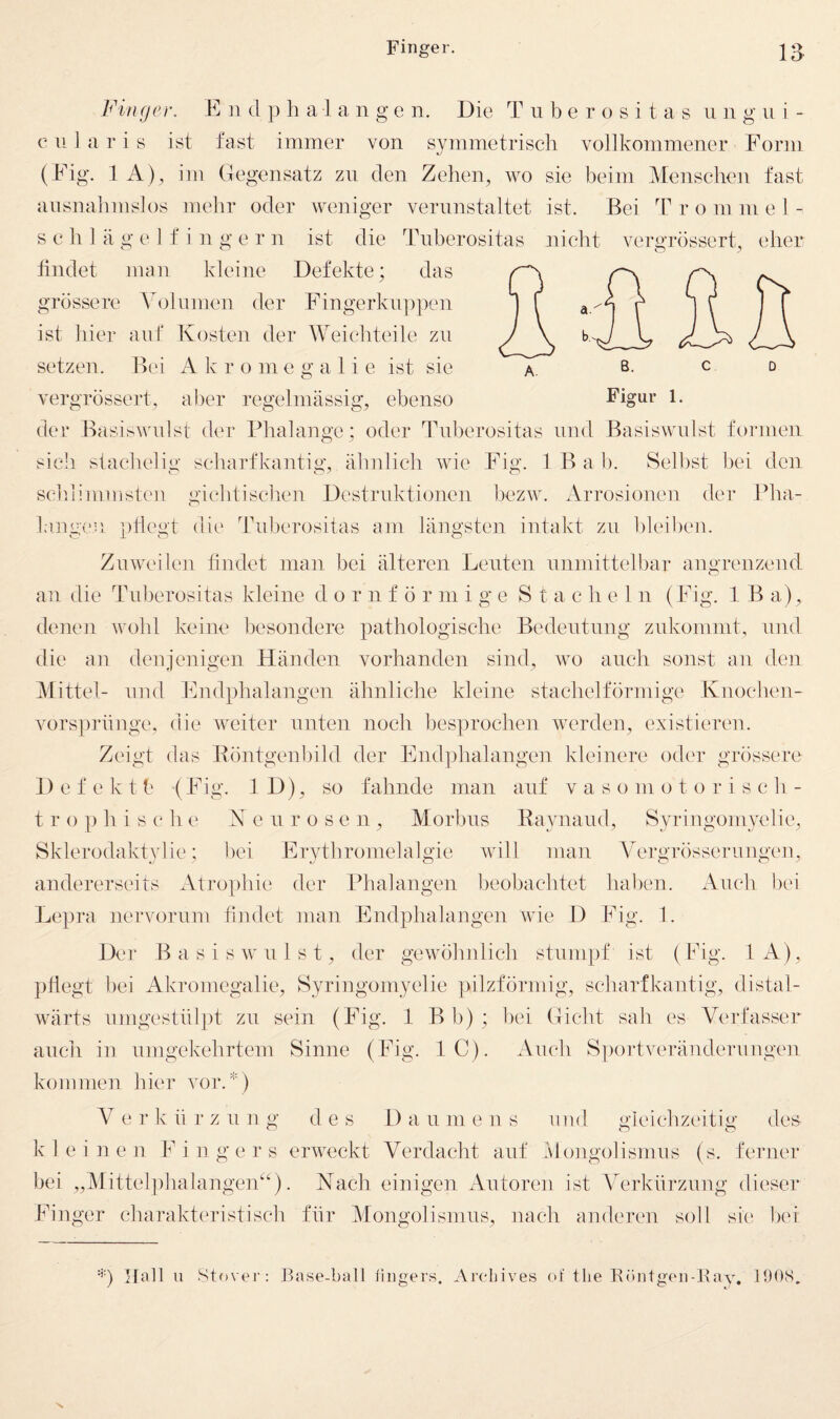 Finger. E ii d p li a 1 a n g e n. Die T u b e r o s i t a s u ii gui- c 11 1 a r i s ist fast immer von symmetrisch vollkommener Form (Fig. lA), im Gegensatz zn den Zehen, wo sie beim Menschen fast ausnahmslos mehr oder weniger verunstaltet ist. Bei Erommel- s e h 1 ä g e 1 f i n g e r n ist die Tuberositas nicht vergrössert, eher tindet imin kleine Defekte; das grössere \bjhimen der Fingerku])pen ist hier auf Kosten der Weiehteile zu setzen. Bei iV k r o m e galt e ist sie vergrössert, aber regelmässig, ebenso der Basiswulst der Phalange ; oder Tuberositas uml Basiswulst formen sieh stachelig scharfkantig, älndich wie Fig. 1 Bah. Selbst bei den seliiimmsten gichtischen Destruktionen bezw. .-Vrrosionen langen jitlegt die Tuberositas am längsten intakt zu bleiben. Zuweilen findet man bei älteren Leuten unmittelbar angrenzend, an die Tuberositas kleine d o r n f ö r in i g e St a c h e 1 n (Fig. 1 B a), denen wohl keine besondere pathologische Bedeutung zukommt, und die an denjenigen Händen vorhanden sind, wo auch soiist an den Mittel- und Findphalangen ähnliche kleine stachelförmige Kuoehen- vorsi)rünge, die weiter nuten noch besprochen werden, existieren. Zeigt das Böntgenbild der Findphalangen kleinere od('r grössere 1) e f e k t b •( Fig. ID), so fahnde man anf v a s o m o t o r i s e h - t r o ]) h i s e h e A e n r o s e n , Morbus Eaynand, Syringomyelie, Sklerodaktylie; bei Erytbromelalgie will man Vergrössernngen, andererseits Atrophie der FTalangen beobachtet haben. Auch bei Lepra nervornm fi]idet man F]ndphalangen wie D Fig. 1. Der Basis willst, der gewöhnlich stumpf ist (Fig. lA), pflegt bei iikromegalie, Syringomyelie pilzförmig, scharfkantig, distal- wärts iimgestiilpt zn sein (Fhg. 1 B b) ; bei Gicht sah es Verfasser auch in nmgekehrtem Sinne (Fhg. IC). Auch Sportverändernngen kommen hier vor.*) V e r k ii r z n n g des D a n in e n s und gieiehzeitig des k lein e n F i n g e r s erweckt Verdacht anf nlongolismns (s. ferner bei „Mitteljihalangen“). Nach einigen Autoren ist Verkürzung dieser Finger charakteristisch für Mongolismus, nach anderen soll sie bei Itall u Stover: Base-ball liiigers. Areliives of tlie RöntgiMi-Eay. IDOS,