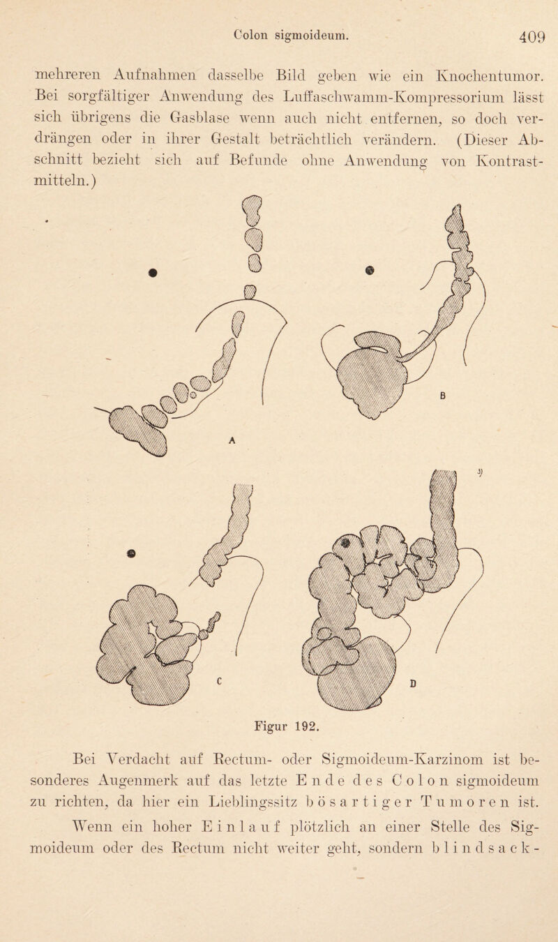 mehreren Anfnahmen dasselbe Bild geben wie ein Knocbeiitninor. Bei sorgfältiger Anwendung des Luffascbwainin-Koinpressorium lässt sich übrigens die Gasblase wenn auch nicht entfernen, so doch ver¬ drängen oder in ihrer Gestalt beträchtlich verändern. (Dieser Ab¬ schnitt bezieht sich auf Befunde ohne x4nwendung von Kontrast¬ mitteln. ) Figur 192. Bei Verdacht auf Eectum- oder Sigmoideum-Karzinom ist be¬ sonderes Augenmerk auf das letzte Ende des Colon sigmoideum zu richten, da hier ein Lieblingssitz bösartiger Tu m o r e n ist. Wenn ein hoher E i n 1 a u f plötzlich an einer Stelle des Sig¬ moideum oder des Eectum nicht weiter geht, sondern b 1 i n d s a c k -