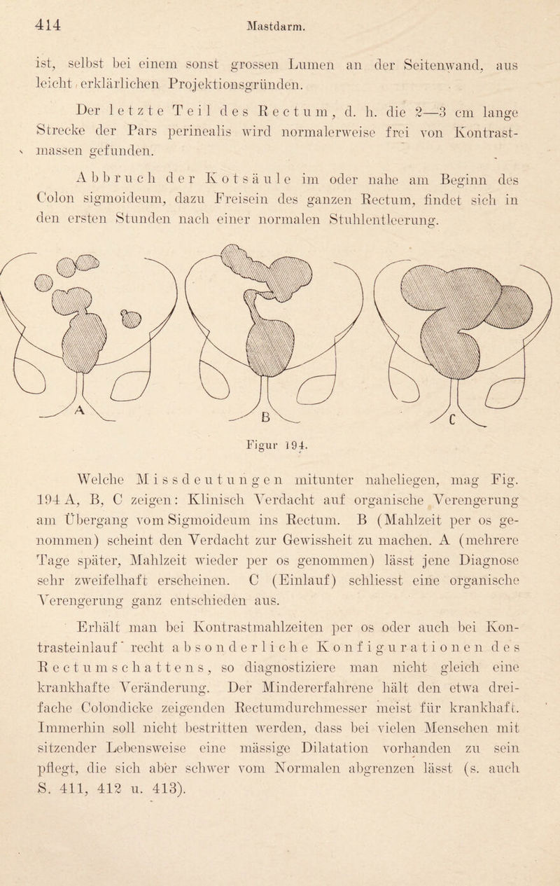 ist, selbst bei einem sonst grossen Lninen an der Seitenwand, aus leicht, erklärlichen Projektionsgründen. Der letzte Teil des Ee c t n m , d. h. die 2—3 cm lange Strecke der Pars perinealis wird normalerweise frei von Kontrast¬ massen gefunden. A b b r n c h der K o t s ä n 1 e im oder nahe am Beginn des Colon sigmoidenm, dazu Freisein des ganzen Kectum, findet sich in den ersten Stunden nach einer normalen Stnhlentleerung. Figur 194. Welche M i s s d e n t n n g e n mitunter naheliegen, mag Fig. 19-1A, B, C zeigen: Klinisch AArdacht auf organische Verengerung am Übergang vom Sigmoidenm ins Eectnm. B (Mahlzeit per os ge¬ nommen) scheint den Verdacht zur Gewissheit zn machen. A (mehrere Tage später, Mahlzeit wieder per os genommen) lässt jene Diagnose sehr zweifelhaft erscheinen. C (Einlauf) schliesst eine organische AArengernng ganz entschieden ans. Erhält man bei Kontrastmahlzeiten per os oder auch hei Kon- trasteinlanf * recht a h s o n d e r 1 i c h e Konfigurationen des E e c t n m s c h a 11 e n s , so diagnostiziere man nicht gleich eine krankhafte AArändernng. Der Mindererfahrene hält den etwa drei¬ fache Colondicke zeigenden Eectnmdnrchmesser meist für krankhaft. Immerhin soll nicht hestritten werden, dass bei vielen Alensehen mit sitzender Lebensweise eine mässige Dilatation vorhanden zn sein pflegt, die sich aber seliwer vom Normalen abgrenzen lässt (s. ancli S. 411, 412 u. 413).