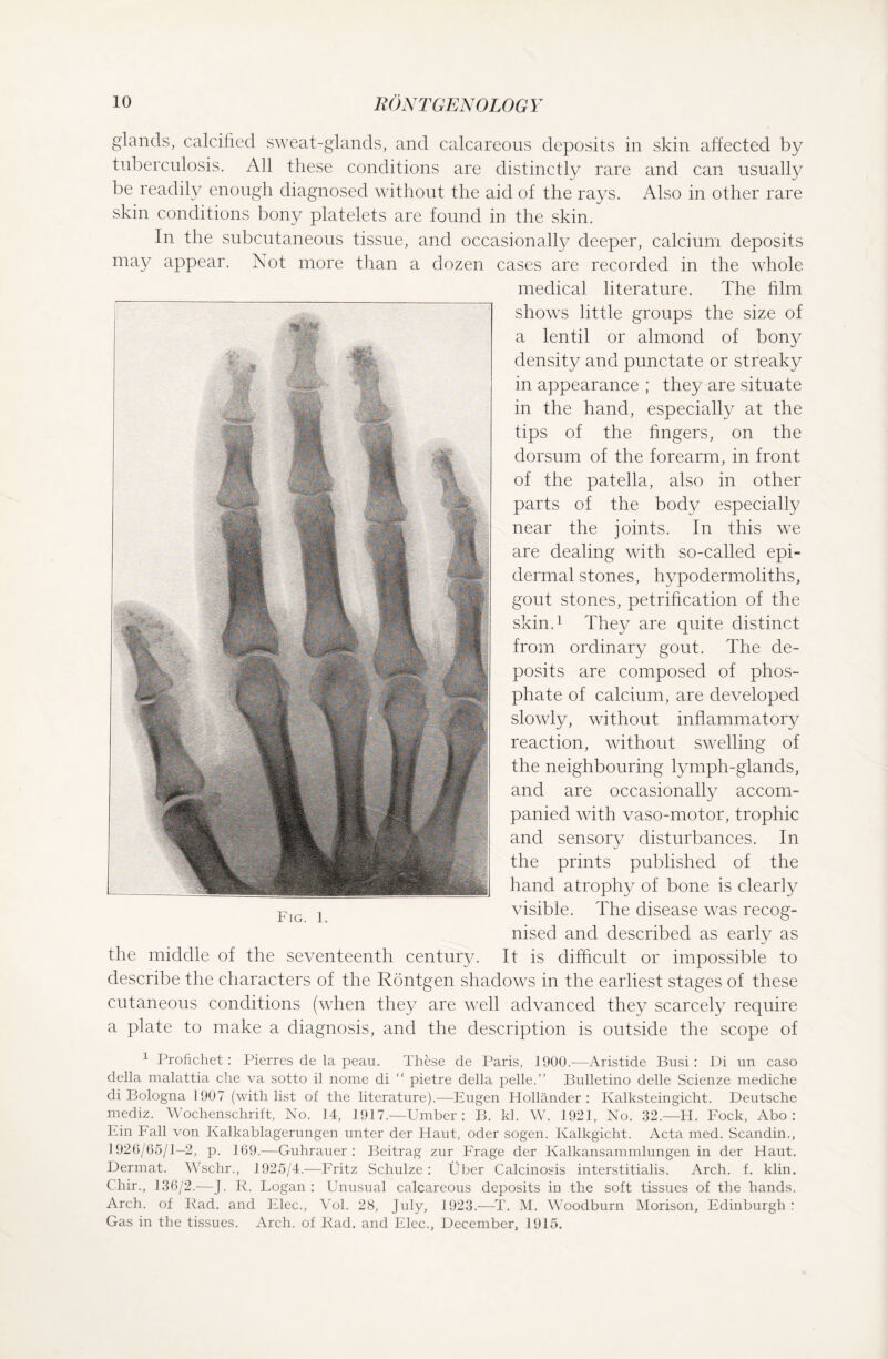 glands, calcified sweat-glands, and calcareous deposits in skin affected by tuberculosis. All these conditions are distinctly rare and can usually be readily enough diagnosed without the aid of the rays. Also in other rare skin conditions bony platelets are found in the skin. In the subcutaneous tissue, and occasionally deeper, calcium deposits may appear. Not more than a dozen cases are recorded in the whole medical literature. The film shows little groups the size of a lentil or almond of bony density and punctate or streaky in appearance ; they are situate in the hand, especially at the tips of the fingers, on the dorsum of the forearm, in front of the patella, also in other parts of the body especially near the joints. In this we are dealing with so-called epi¬ dermal stones, hypodermoliths, gout stones, petrification of the skin.1 They are quite distinct from ordinary gout. The de¬ posits are composed of phos¬ phate of calcium, are developed slowly, without inflammatory reaction, without swelling of the neighbouring lymph-glands, and are occasionally accom¬ panied with vaso-motor, trophic and sensory disturbances. In the prints published of the hand atrophy of bone is clearly visible. The disease was recog¬ nised and described as early as the middle of the seventeenth century. It is difficult or impossible to describe the characters of the Röntgen shadows in the earliest stages of these cutaneous conditions (when they are well advanced they scarcely require a plate to make a diagnosis, and the description is outside the scope of 1 Profichet: Pierres de la peau. These de Paris, 1900.-—Aristide Busi: Di un caso della malattia che va sotto il nome di “ pietre della pelle.” Bulletino delle Scienze mediche di Bologna 1907 (with list of the literature).—Eugen Holländer: Kalksteingicht. Deutsche mediz. Wochenschrift, No. 14, 1917.—Umber: B. kl. W. 1921, No. 32.—H. Fock, Abo: Ein Fall von Kalkablagerungen unter der Haut, oder sogen. Kalkgicht. Acta med. Scandin., 1926/65/1-2, p. 169.—Guhrauer : Beitrag zur Frage der Kalkansammlungen in der Haut. Dermat. Wschr., 1925/4.—Fritz Schulze: Über Calcino sis interstitialis. Arch. f. klin. Chir., 136/2.—J. R. Fogan : Unusual calcareous deposits in the soft tissues of the hands. Arch, of Rad. and Elec., Vol. 28, July, 1923.—T. M. Woodburn Morison, Edinburgh : Gas in the tissues. Arch, of Rad. and Elec., December, 1915.