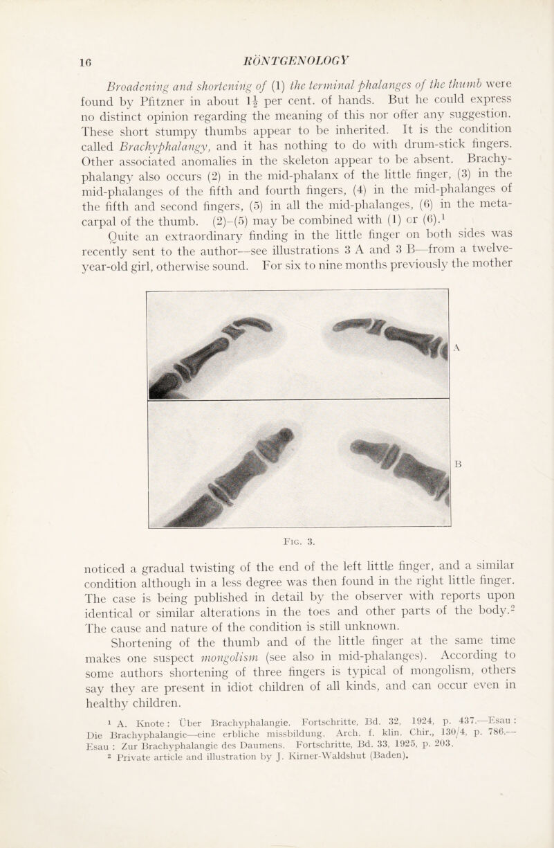 Broadening and shortening of (1) the terminal phalanges of the thumb were found by Pfitzner in about \\ per cent, of hands. But he could express no distinct opinion regarding the meaning of this nor offer any suggestion. These short stumpy thumbs appear to be inherited. It is the condition called Brachyphalangy, and it has nothing to do with drum-stick fingers. Other associated anomalies in the skeleton appear to be absent. Brachy¬ phalangy also occurs (2) in the mid-phalanx of the little finger, (3) in the mid-phalanges of the fifth and fourth fingers, (4) in the mid-phalanges of the fifth and second fingers, (5) in all the mid-phalanges, (6) in the meta¬ carpal of the thumb. (2)-(5) may be combined with (1) or (6).1 Quite an extraordinary finding in the little finger on both sides was recently sent to the author—see illustrations 3 A and 3 B—from a twelve- year-old girl, otherwise sound. For six to nine months previously the mother Fig. 3. noticed a gradual twisting of the end of the left little finger, and a similar condition although in a less degree was then found in the right little finger. The case is being published in detail by the observer with reports upon identical or similar alterations in the toes and other parts of the body.2 The cause and nature of the condition is still unknown. Shortening of the thumb and of the little finger at the same time makes one suspect mongolism (see also in mid-phalanges). According to some authors shortening of three fingers is typical of mongolism, others say they are present in idiot children of all kinds, and can occur even in healthy children. 1 A. Knote : Über Brachyphalangie. Fortschritte, Bd. 32, 1924, p. 437. Fsau : Die Brachyphalangie—eine erbliche missbildung. Arch. f. klin. Chir., 130/4, p. /SO. Esau : Zur Brachyphalangie des Daumens. Fortschritte, Bd. 33, 1925, p. 203. 2 Private article and illustration by J. Kirner-Waldshut (Baden).