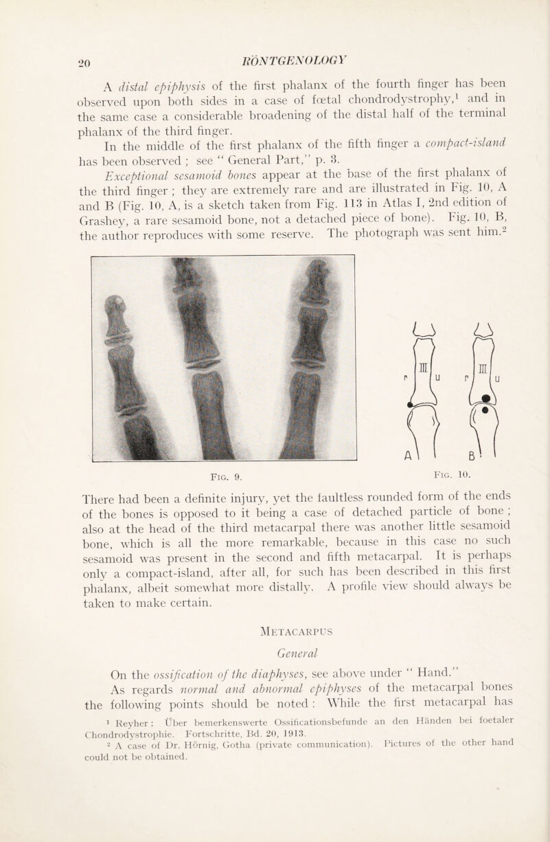 A distal epiphysis of the first phalanx of the fourth finger has been observed upon both sides in a case of foetal chondrodystrophy,1 and in the same case a considerable broadening of the distal half of the terminal phalanx of the third finger. In the middle of the first phalanx of the fifth huger a compact-island has been observed ; see “ General Part,” p. 8. Exceptional sesamoid bones appear at the base of the first phalanx of the third finger ; they are extremely rare and are illustrated in Fig. 10, A and B (Fig. 10, A, is a sketch taken from Fig. 113 in Atlas I, 2nd edition of Grashey, a rare sesamoid bone, not a detached piece of bone), big. 10, B, the author reproduces with some reserve. The photograph was sent him.2 Fig. 9. Fig. 10. There had been a definite injury, yet the faultless rounded form of the ends of the bones is opposed to it being a case of detached particle of bone ; also at the head of the third metacarpal there was another little sesamoid bone, which is all the more remarkable, because in this case no such sesamoid was present in the second and fifth metacarpal. It is perhaps only a compact-island, after all, for such has been described in this first phalanx, albeit somewhat more distally. A profile view should always be taken to make certain. Metacarpus General On the ossification of the diaphyses, see above under “ Hand. As regards normal and abnormal epiphyses of the metacarpal bones the following points should be noted : While the first metacarpal has 1 Reyher : Über bemerkenswerte Ossificationsbefunde an den Händen bei foetaler Chondrodystrophie. Fortschritte, Bd. 20, i9I3. 2 A case of Dr. Hornig, Gotha (private communication). Pictures of the other hand could not be obtained.