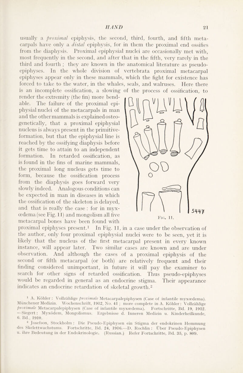 usually a proximal epiphysis, the second, third, fourth, and fifth meta- carpals have only a distal epiphysis, for in them the proximal end ossihes from the diaphysis. Proximal epiphysial nuclei are occasionally met with, most frequently in the second, and after that in the fifth, very rarely in the third and fourth ; they are known in the anatomical literature as pseudo¬ epiphyses. In the whole division of vertebrata proximal metacarpal epiphyses appear only in these mammals, which the fight for existence has forced to take to the water, in the whales, seals, and walruses. Here there is an incomplete ossification, a slowing of the process of ossification, to render the extremity (the fin) more bend¬ able. The failure of the proximal epi¬ physial nuclei of the metacarpals in man and the other mammals is explained osteo- genetically, that a proximal epiphysial nucleus is always present in the primitive- formation, but that the epiphysial line is reached by the ossifying diaphysis before it gets time to attain to an independent formation. In retarded ossification, as is found in the fins of marine mammals, the proximal long nucleus gets time to form, because the ossification process from the diaphysis goes forward very slowly indeed. Analogous conditions can be expected in man in diseases in which the ossification of the skeleton is delayed, and that is really the case : for in myx- oedema (see Fig. 11) and mongolism all five metacarpal bones have been found with proximal epiphyses present.1 In Fig. 11, in a case under the observation of the author, only four proximal epiphysial nuclei were to be seen, yet it is likely that the nucleus of the first metacarpal present in every known instance, will appear later. Two similar cases are known and are under observation. And although the cases of a proximal epiphysis of the second or fifth metacarpal (or both) are relatively frequent and their finding considered unimportant, in future it will pay the examiner to search for other signs of retarded ossification. Thus pseudo-epiphyses would be regarded in general as an endocrine stigma. Their appearance indicates an endocrine retardation of skeletal growth.2 544? Fig. 11, 1 A. Köhler : Vollzählige proximale Metacarpalepiphysen (Case of infantile myxcedema). Münchener Medizin. Wochenschrift, 1912, No. 41 ; more complete in A. Köhler: Vollzählige proximale Metacarpalepiphysen (Case of infantile myxoedema). Fortschritte, Bd. 19, 1912. Siegert : Myxödem, Mongolismus. Frgebnisse d. Inneren Medizin u. Kinderheilkunde, 6. Bd., 1910. 2 Josefson, Stockholm : Die Pseudo-Epiphysen ein Stigma der endokrinen Hemmung des Skelettwachstums. Fortschritte, Bd. 24, 1916.—D. Rochlin : Über Pseudo-Epiphysen u. ihre Bedeutung in der Endokrinologie. (Russian.) Refer Fortschritte, Bd. 35, p. 809.
