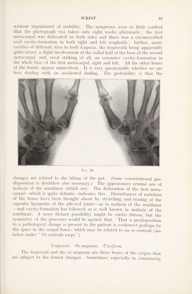 without impairment of mobility. The symptoms were so little marked that the photograph was taken only eight weeks afterwards ; the first metacarpal was dislocated on both sides and there was a circumscribed oval cavity-formation in both right and left scaphoids ; further, many cavities of different sizes in both trapezia, the trapezoids being apparently quite intact, a slight involvement of the radial half of the base of the second metacarpal, and, most striking of all, an extensive cavity-formation in the whole base of the first metacarpal, right and left. All the other bones of the hands appear uninvolved. It is very questionable whether we are here dealing with an accidental finding. The probability is that the Fig. 18. changes are related to the lifting of the pot. (Some constitutional pre¬ disposition is doubtless also necessary.) The appearances remind one of malacia of the semilunar (which see). The dislocation of the first meta¬ carpal—which is quite definite—indicates this. Disturbances of nutrition of the bones have been brought about by stretching and tearing of the capsular ligaments of the affected joints—as in malacia of the semilunar -and cavity-formation has followed, as is well known in malacia of the semilunar. A more distant possibility might be ostitis fibrosa, but the symmetry of the processes would be against that. That a predisposition to a pathological change is present in the patient is evidenced perhaps by the space in the carpal bones, which may be related to an os centrale (see below under “ Os centrale carpi ”). Trapezoid. Os magnum. Unciform The trapezoid and the os magnum are those bones of the carpus that are subject to the fewest changes. Sometimes, especially in commencing
