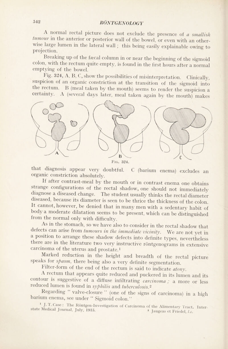 A normal rectal picture does not exclude the presence of a smallish tumour in the anterior or posterior wall of the bowel, or even with an other- v ise large lumen in the lateral wall; this being easily explainable owing- to projection. ~ 6 Breaking up of the faecal column in or near the beginning of the sigmoid colon, with the rectum quite empty, is found in the first hours after a normal emptying of the bowel. big. 324, A, B, C, show the possibilities of misinterpretation. Clinically, suspicion of an organic constriction at the transition of the sigmoid into the lectum. B (meal taken by the mouth) seems to render the suspicion a certainty. A (several days later, meal taken again by the mouth) makes that diagnosis appear very doubtful. C (barium enema) excludes an organic constriction absolutely. If after contrast-meal by the mouth or in contrast enema one obtains st langt conhgui ations of the rectal shadow, one should not immediately diagnose a diseased change. The student usually thinks the rectal diameter diseased, because its diameter is seen to be thrice the thickness of the colon. It cannot, however, be denied that in many men with a sedentary habit of body a moderate dilatation seems to be present, which can be distinguished from the normal only with difficulty. As m the stomach, so we have also to consider in the rectal shadow that defects can arise from tumours in the immediate vicinity. We are not vet in a position to arrange these shadow defects into definite types, nevertheless there are in the literature two very instructive röntgenograms in extensive carcinoma of the uterus and prostate.1 Marked reduction in the height and breadth of the rectal picture speaks for spasm, there being also a very definite segmentation. filter-form of the end of the rectum is said to indicate atony. A rectum that appears quite reduced and puckered in its lumen and its contour is suggestive of a diffuse infiltrating carcinoma ; a more or less reduced lumen is found in syphilis and tuberculosis.2 . Re§arding valve-closure ” (one of the signs of carcinoma) in a high barium enema, see under “ Sigmoid colon/’ 1 J' }/ (,ase : ihe Röntgen-Investigation of Carcinoma of the Alimentary Tract. Inter¬ state Medical Journal, July, 1915. 2 Jaugeas et Fricdel)