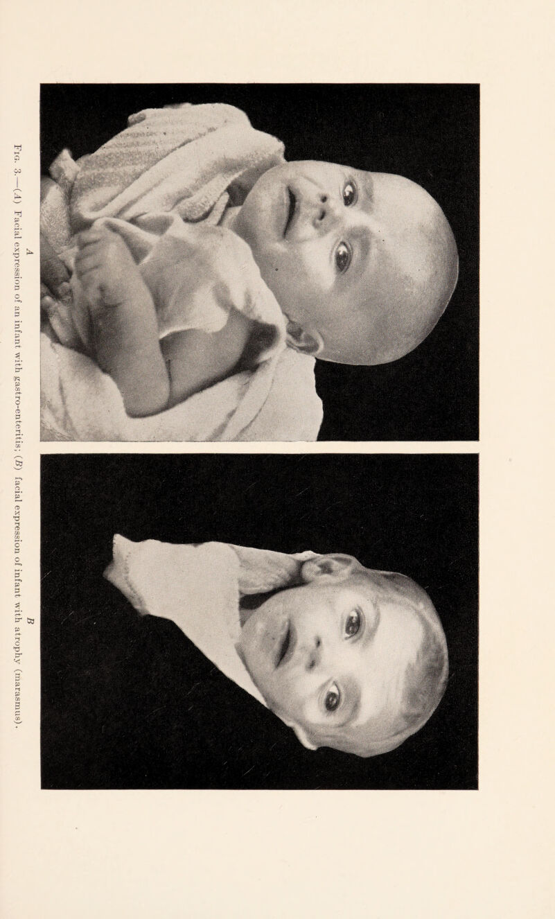 Fig. 3.—(A) Facial expression of an infant with gastro-enteritis; (B) facial expression of infant with atrophy (marasmus).