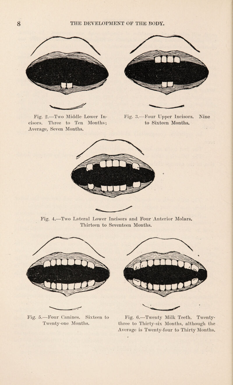 Fig. 2.—Two Middle Lower In¬ cisors. Three to Ten Months; Average, Seven Months. Fig. O o.- -Four Upper Incisors, to Sixteen Months. Nine Fig. 4.—Two Lateral Lower Incisors and Four Anterior Molars. Thirteen to Seventeen Months. Fig. 5.—Four Canines. Sixteen to Twenty-one Months. Fig. G.—Twenty Milk Teeth. Twenty- three to Thirty-six Months, although the Average is Twenty-four to Thirty Months.