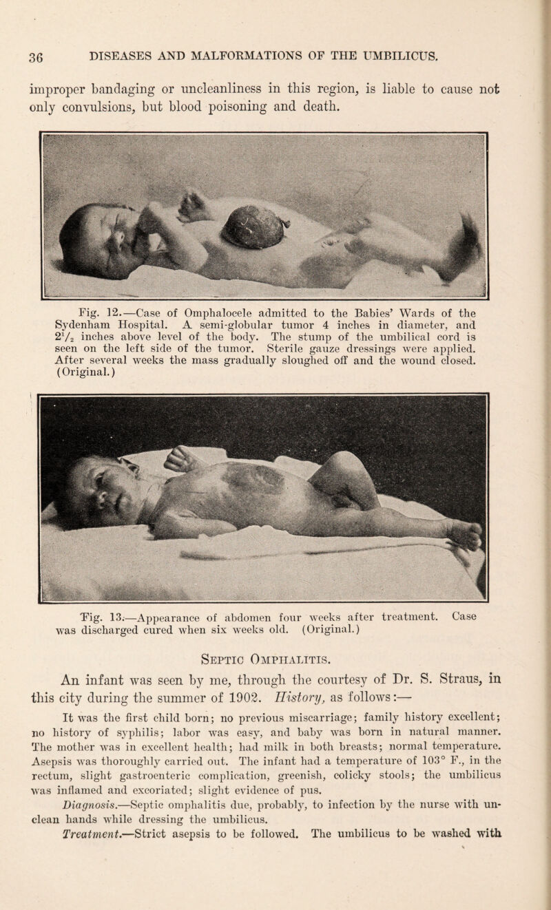 improper bandaging or nncleanliness in this region, is liable to cause not only convulsions, but blood poisoning and death. Fig. 12.—Case of Omphalocele admitted to the Babies’ Wards of the Sydenham Hospital. A semi-globular tumor 4 inches in diameter, and 2V2 inches above level of the body. The stump of the umbilical cord is seen on the left side of the tumor. Sterile gauze dressings were applied. After several weeks the mass gradually sloughed off and the wound closed. (Original.) Eig. 13;—Appearance of abdomen four weeks after treatment. Case was discharged cured when six weeks old. (Original.) Septic Omphalitis. An infant was seen by me, through the courtesy of Dr. S. Straus, in this city during the summer of 1902. History, as follows:— It was the first child born; no previous miscarriage; family history excellent; no history of syphilis; labor was easy, and baby was born in natural manner. The mother was in excellent health; had milk in both breasts; normal temperature. Asepsis was thoroughly carried out. The infant had a temperature of 103° F., in the rectum, slight gastroenteric complication, greenish, colicky stools; the umbilicus was inflamed and excoriated; slight evidence of pus. Diagnosis.—Septic omphalitis due, probably, to infection by the nurse with un¬ clean hands while dressing the umbilicus. Treatment.—Strict asepsis to be followed. The umbilicus to be washed with
