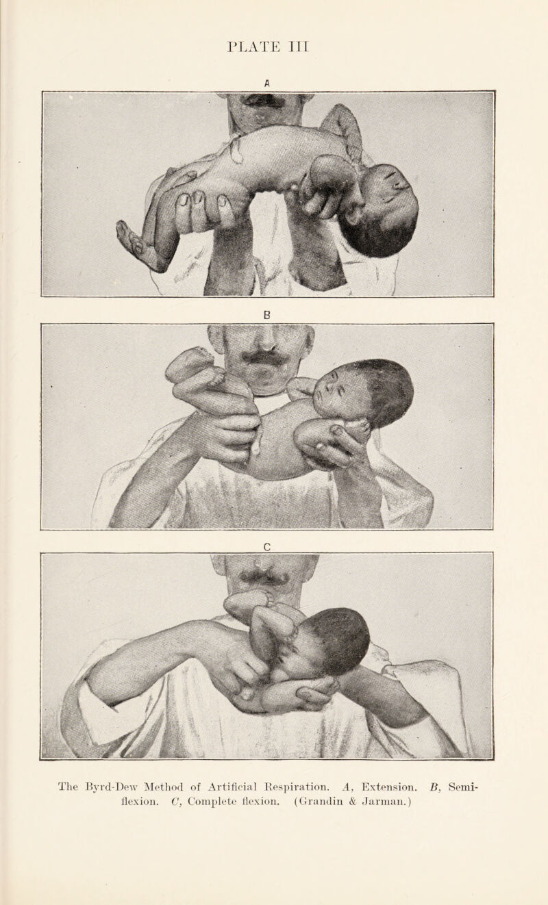 PLATE III The Byrd-Dew Method of Artificial Respiration. A, Extension flexion. C, Complete flexion. (Grandin & Jarman.) B, Semi