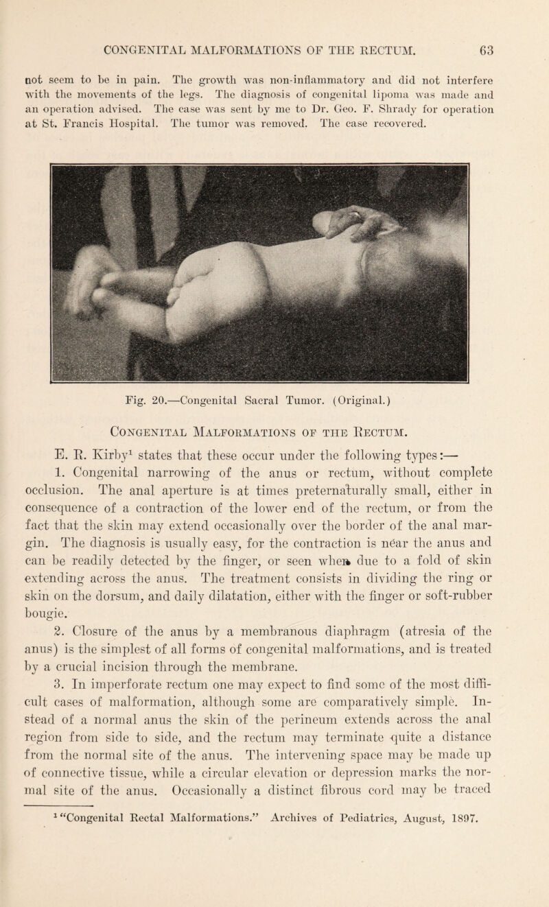 not seem to be in pain. The growth was non-inflammatory and did not interfere with the movements of the legs. The diagnosis of congenital lipoma was made and an operation advised. The case was sent by me to Dr. Geo. F. Slirady for operation at St. Francis Hospital. The tumor was removed. The case recovered. Fig. 20.—Congenital Sacral Tumor. (Original.) Congenital Malformations of the Rectum. E. R. Kirby1 states that these occur under the following types:— 1. Congenital narrowing of the anus or rectum, without complete occlusion. The anal aperture is at times preternaturally small, either in consequence of a contraction of the lower end of the rectum, or from the fact that the skin may extend occasionally over the border of the anal mar¬ gin. The diagnosis is usually easy, for the contraction is near the anus and can be readily detected by the finger, or seen wliei* due to a fold of skin extending across the anus. The treatment consists in dividing the ring or skin on the dorsum, and daily dilatation, either with the finger or soft-rubber bougie. 2. Closure of the anus by a membranous diaphragm (atresia of the anus) is the simplest of all forms of congenital malformations, and is treated by a crucial incision through the membrane. 3. In imperforate rectum one may expect to find some of the most diffi¬ cult cases of malformation, although some are comparatively simple. In¬ stead of a normal anus the skin of the perineum extends across the anal region from side to side, and the rectum may terminate -quite a distance from the normal site of the anus. The intervening space may be made up of connective tissue, while a circular elevation or depression marks the nor¬ mal site of the anus. Occasionally a distinct fibrous cord may be traced 1 “Congenital Rectal Malformations.” Archives of Pediatrics, August, 1897.