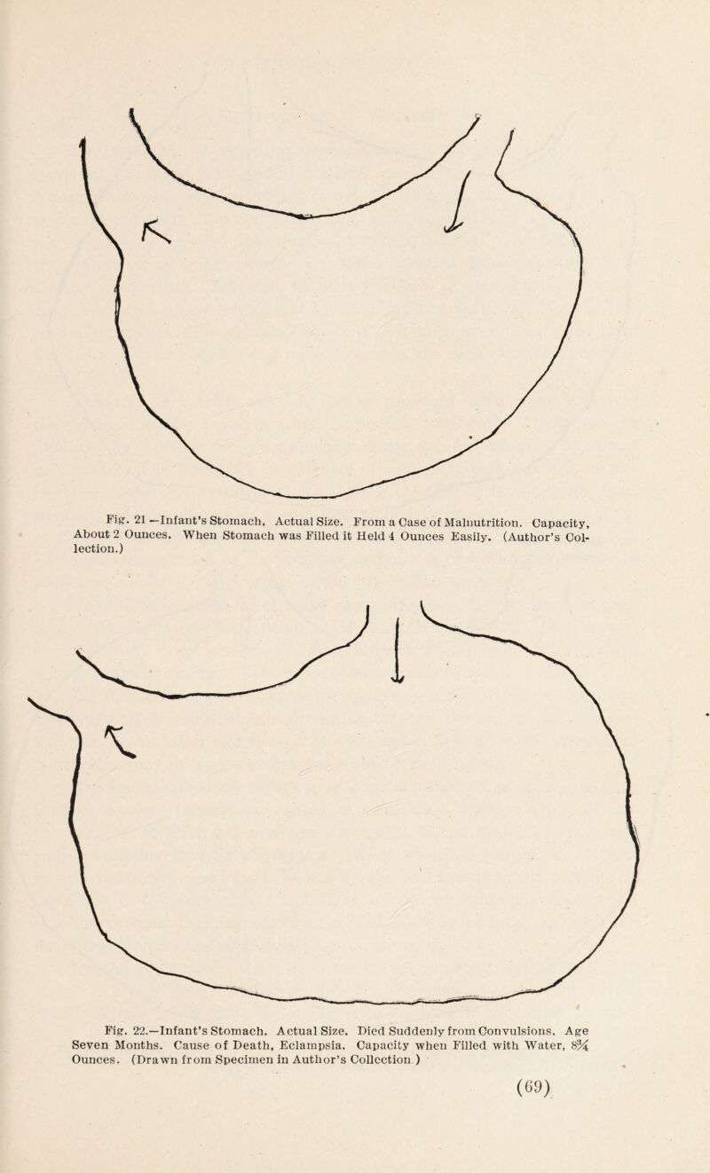 Fig. 21—Infant’s Stomach, Actual Size. From a Case of Malnutrition. Capacity, About 2 Ounces. When Stomach was Filled it Held 4 Ounces Easily. (Author’s Col¬ lection.) Fig. 22.—Infant’s Stomach. Actual Size. Died Suddenly from Convulsions. Age Seven Months. Cause of Death, Eclampsia. Capacity when Filled with Water, 8% Ounces. (Drawn from Specimen in Author’s Collection )