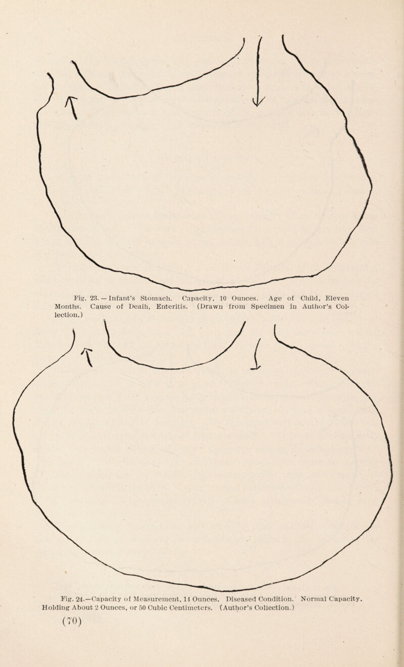 Fig. 24.—Capacity of Measurement, 14 Ounces. Diseased Condition. Normal Capacity. Holding About 2 Ounces, or 50 Cubic Centimeters. (Author’s Collection.)