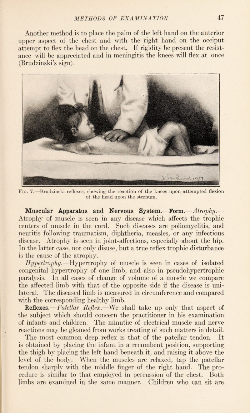 Another method is to place the palm of the left hand on the anterior upper aspect of the chest and with the right hand on the occiput attempt to flex the head on the chest. If rigidity be present the resist¬ ance will be appreciated and in meningitis the knees will flex at once (Brudzinski’s sign). Fig. 7.—Brudzinski reflexes, showing the reaction of the knees upon attempted flexion of the head upon the sternum. Muscular Apparatus and Nervous System.—Form.—Atrophy.— Atrophy of muscle is seen in any disease which affects the trophic centers of muscle in the cord. Such diseases are poliomyelitis, and neuritis following traumatism, diphtheria, measles, or any infectious disease. Atrophy is seen in joint-affections, especially about the hip. In the latter case, not only disuse, but a true reflex trophic disturbance is the cause of the atrophy. Hypertrophy.—Hypertrophy of muscle is seen in cases of isolated congenital hypertrophy of one limb, and also in pseudohypertrophic paralysis. In all cases of change of volume of a muscle we compare the affected limb with that of the opposite side if the disease is uni¬ lateral. The diseased limb is measured in circumference and compared with the corresponding healthy limb. Reflexes.—Patellar Reflex.—We shall take up only that aspect of the subject which should concern the practitioner in his examination of infants and children. The minutife of electrical muscle and nerve reactions may be gleaned from works treating of such matters in detail. The most common deep reflex is that of the patellar tendon. It is obtained by placing the infant in a recumbent position, supporting the thigh by placing the left hand beneath it, and raising it above the level of the body. When the muscles are relaxed, tap the patellar tendon sharply with the middle finger of the right hand. The pro¬ cedure is similar to that employed in percussion of the chest. Both limbs are examined in the same manner. Children who can sit are